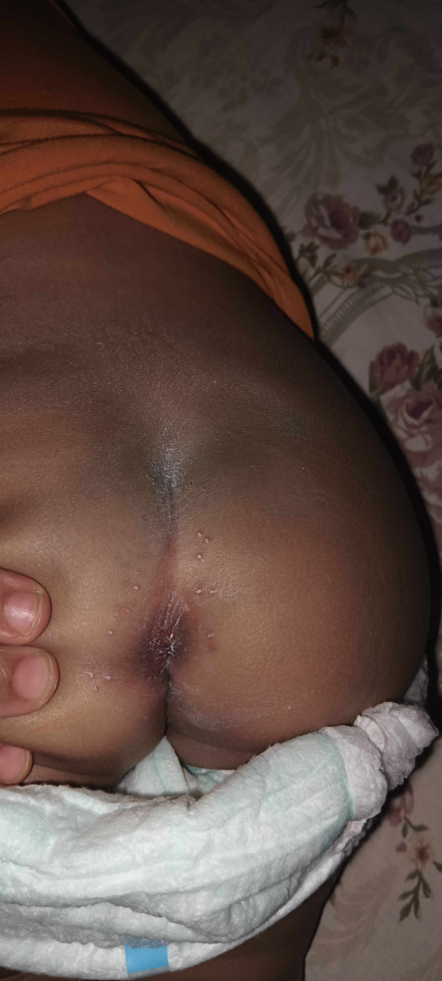 حبوب في المنطقة الحساسة لا تتحسن