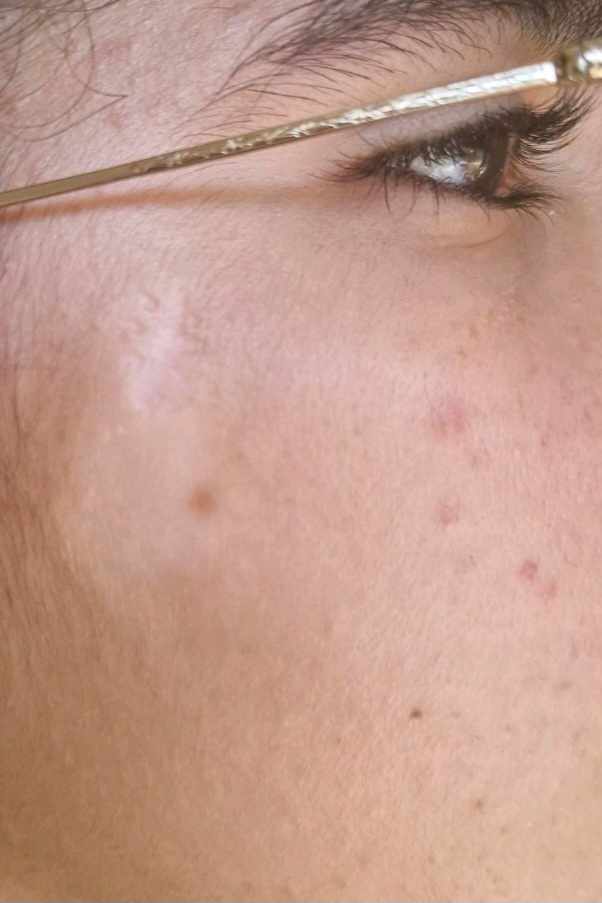 إزالة شعر الوجه بالليزر: 7 آثار جانبية