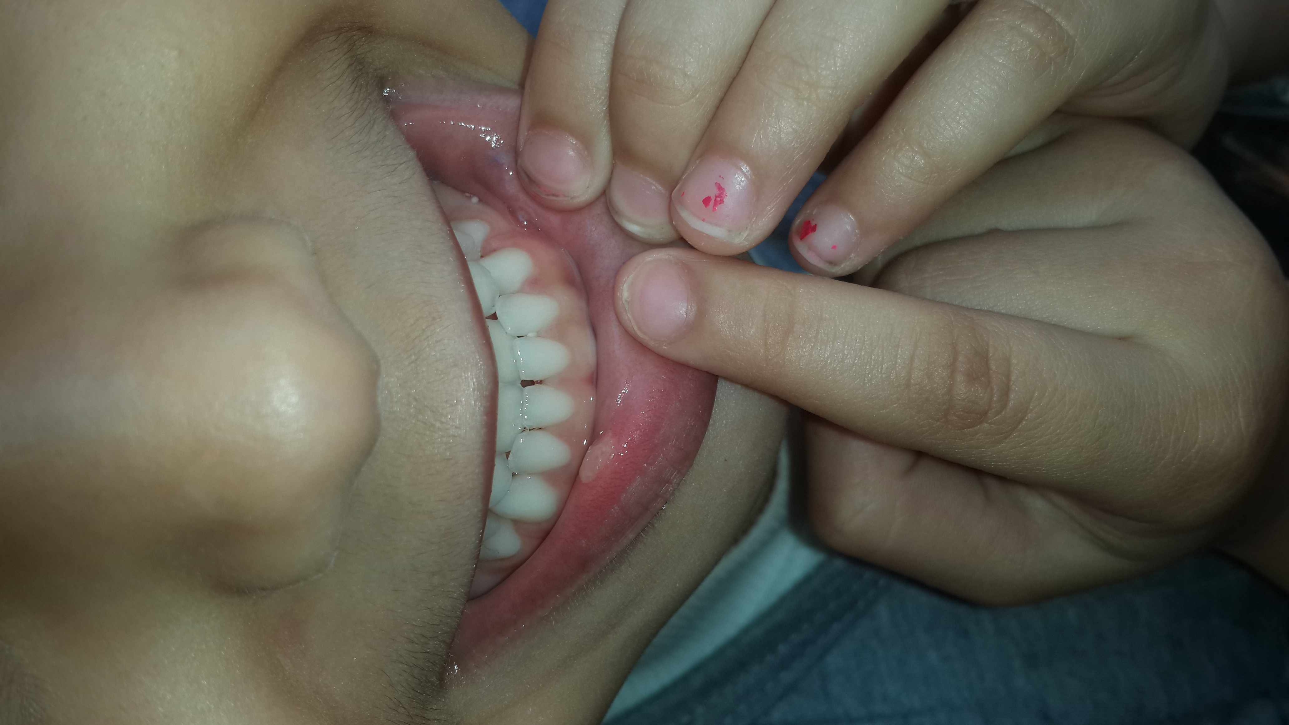 التهابات و حبوب متكررة في الفم