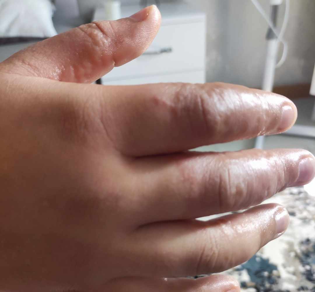 التهاب اصابع اليد من العمل بالمقص