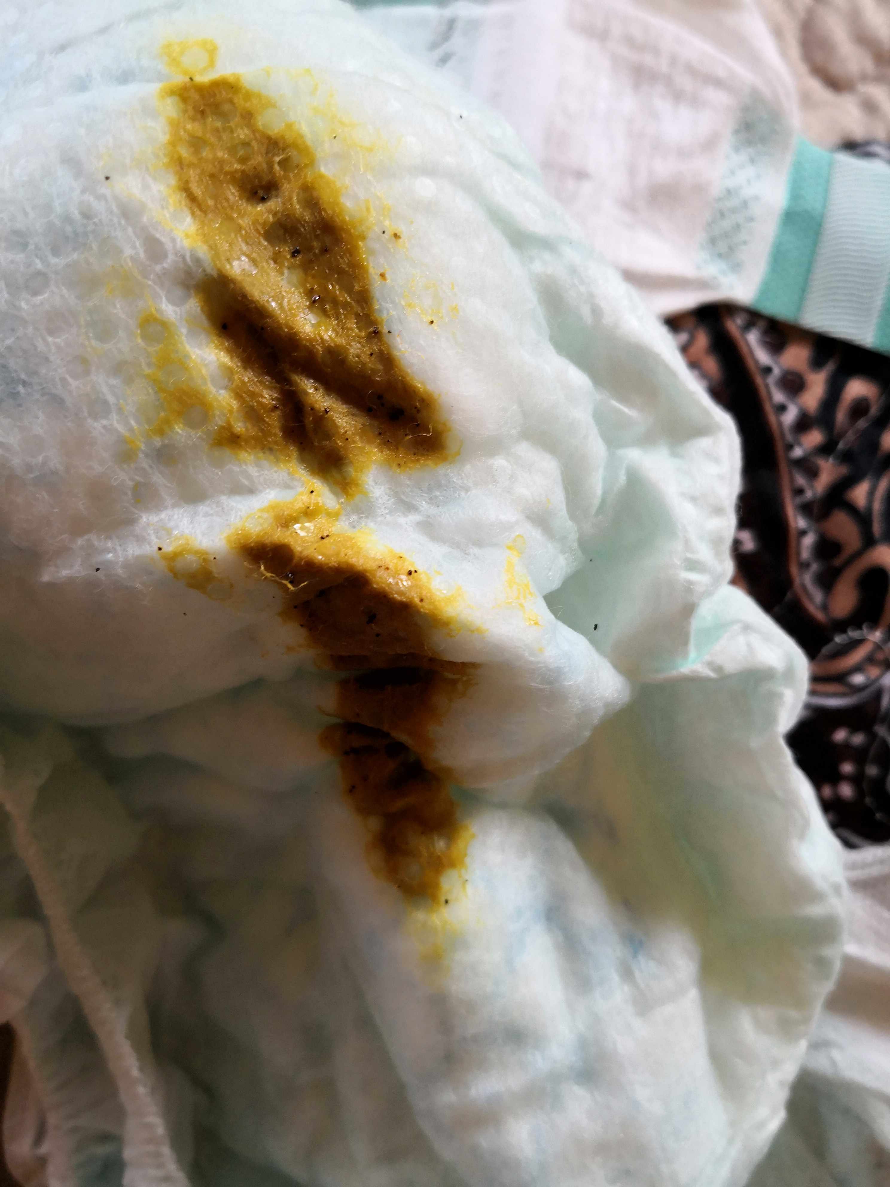 وجود قطع بيضاء صغيره في البول