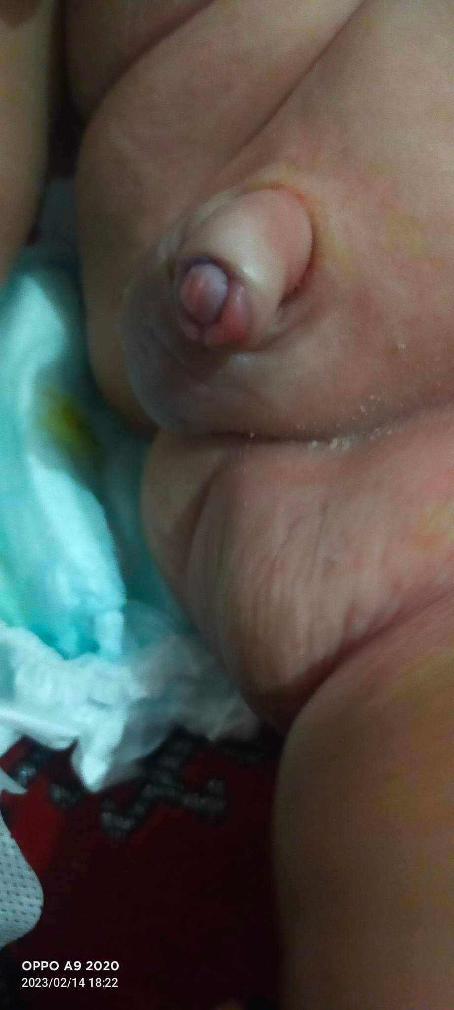 هل ختان الطفل يحتاج تدخل