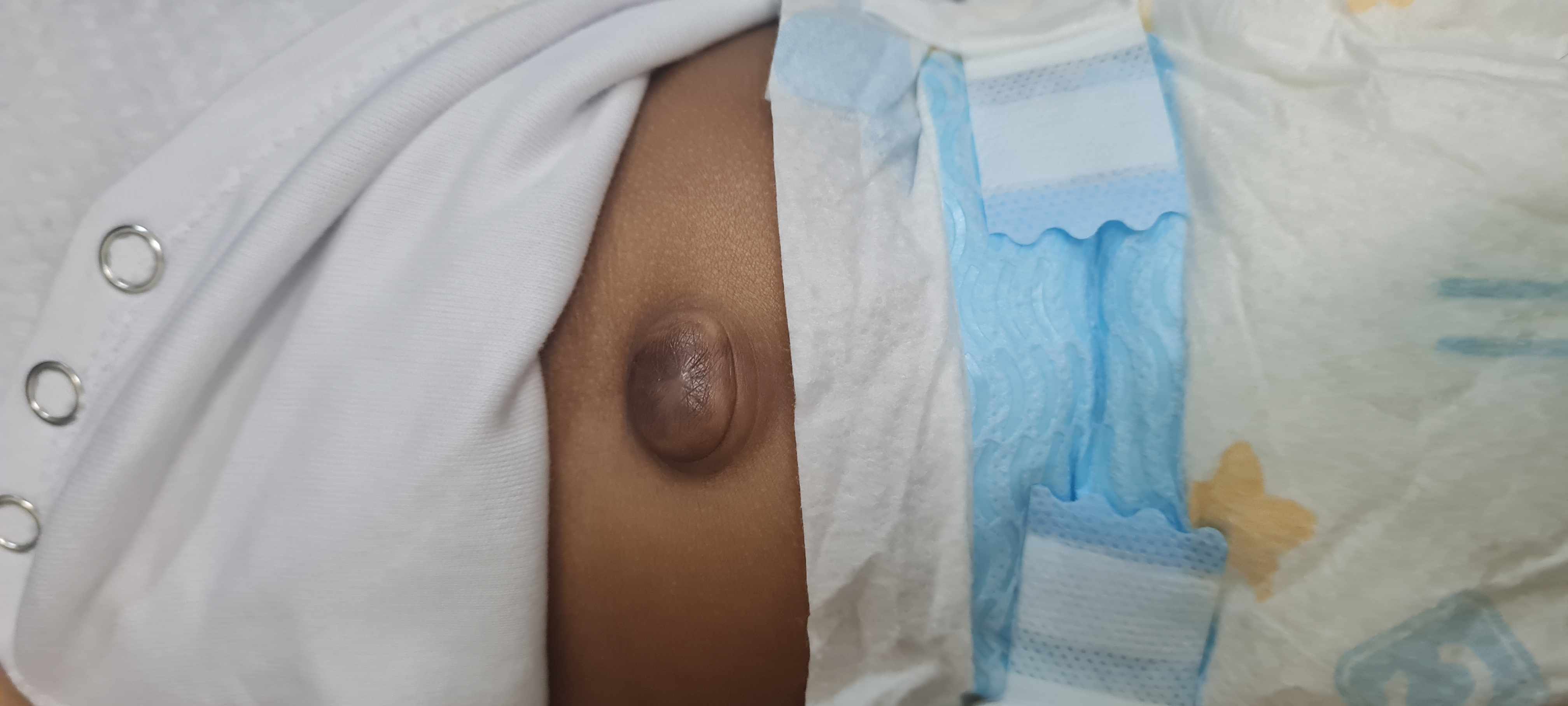 بروز سرة الرضيع 5 أسباب