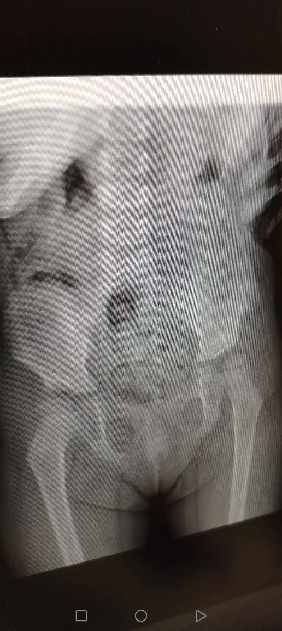 صورة خلع الولادة بعد العملية الجراحية