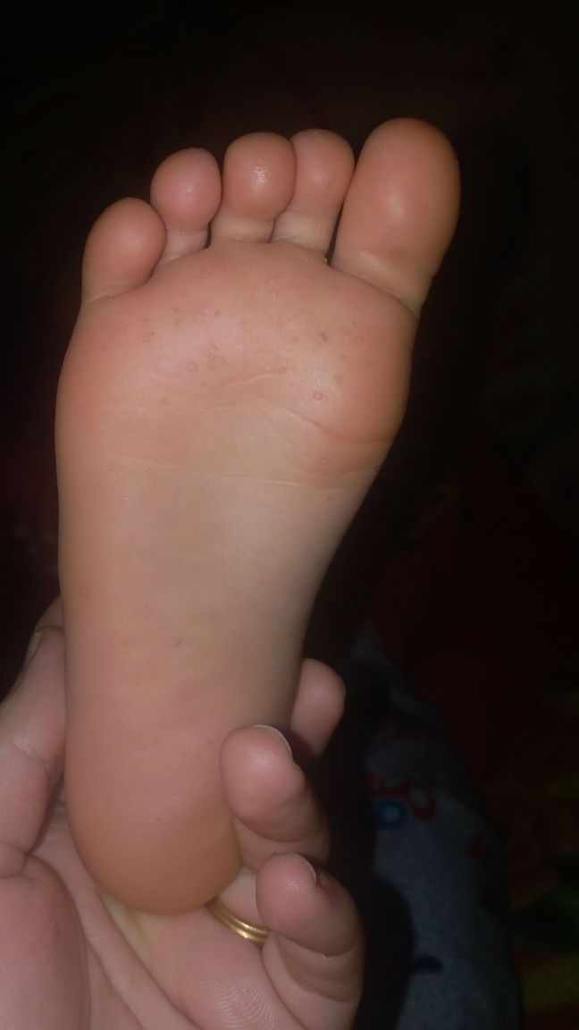 نقط اسفل رجل الطفل