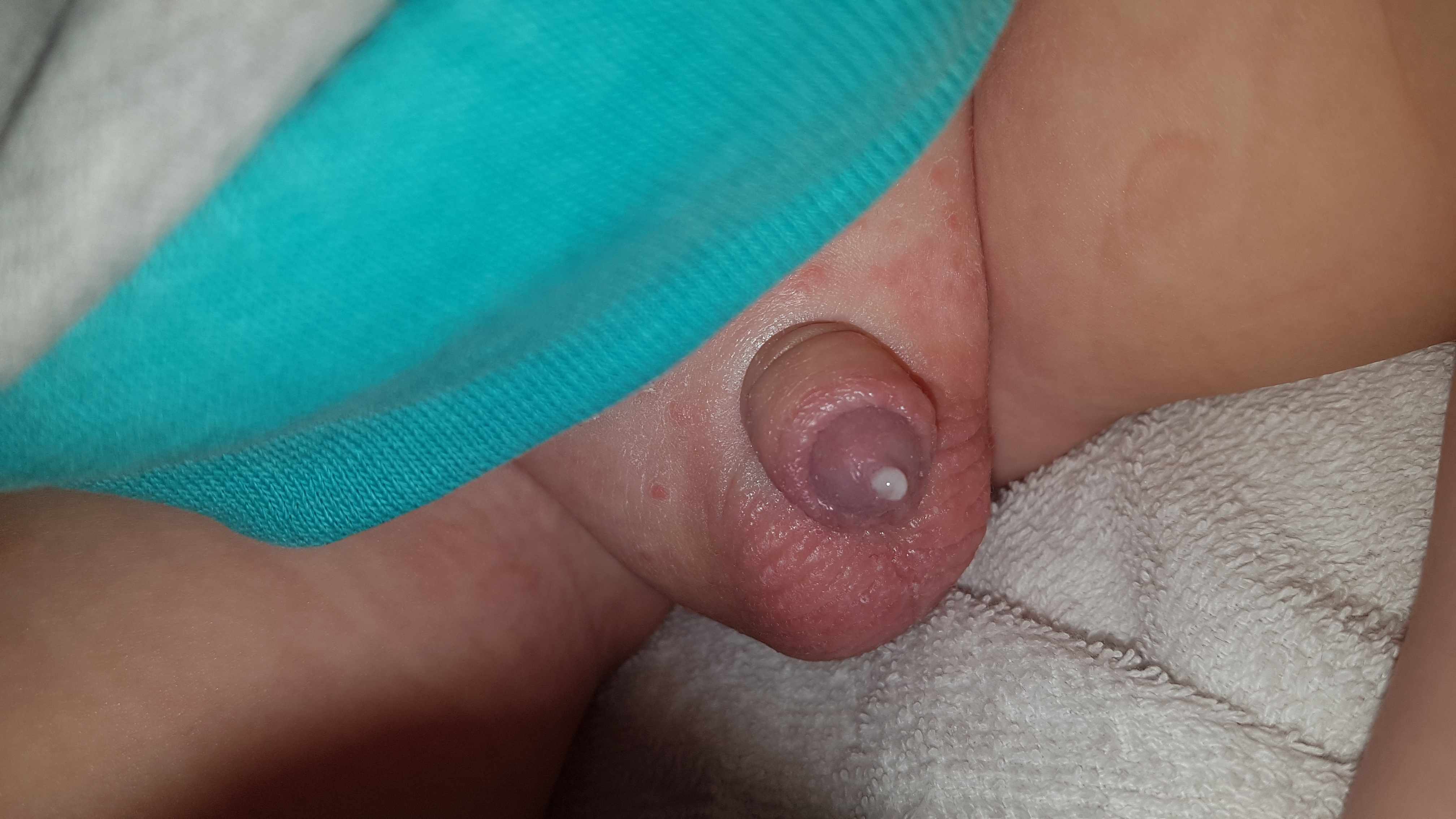 خروج نقط و قطره بيضاء من فتحة البول للطفل
