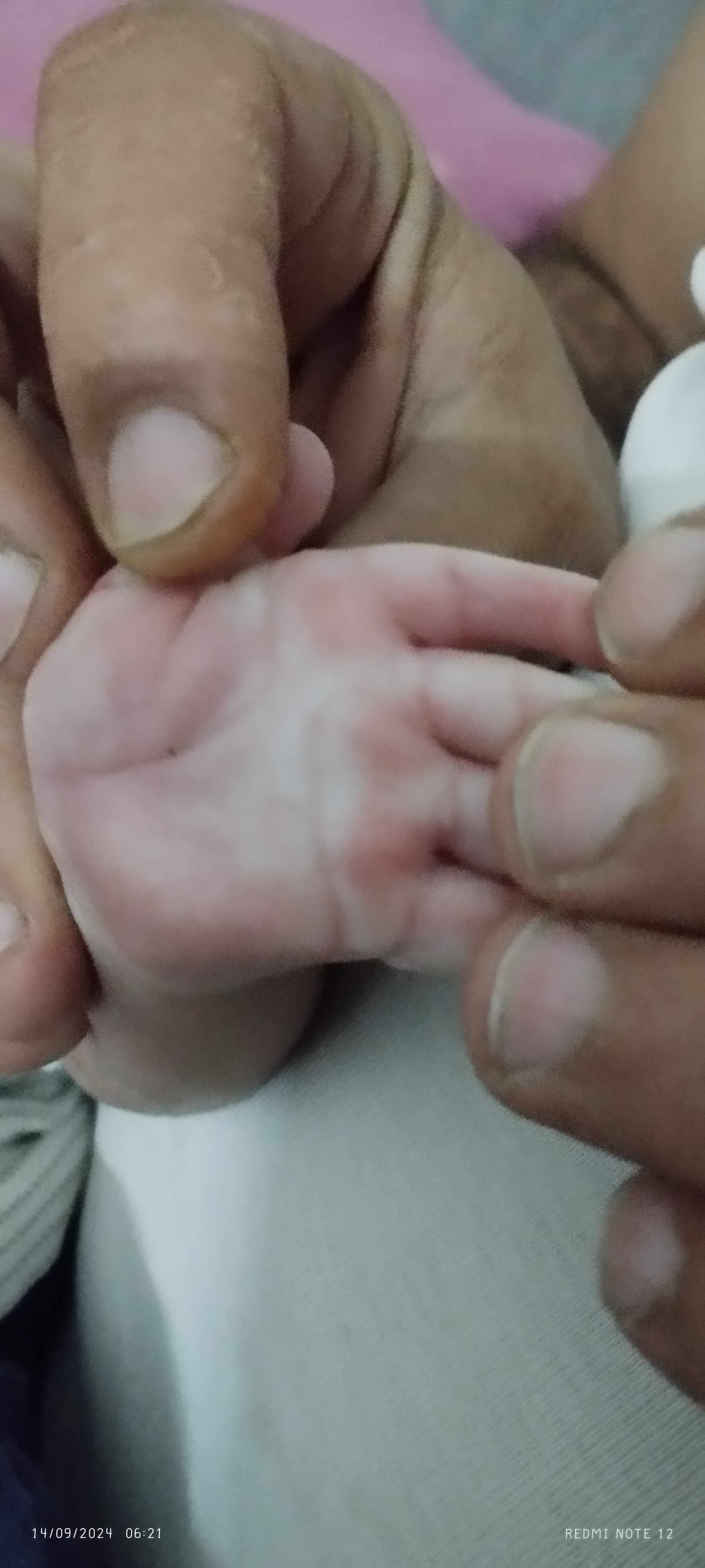 وجود خطين فقط في كف يد الطفل: 3 أسباب