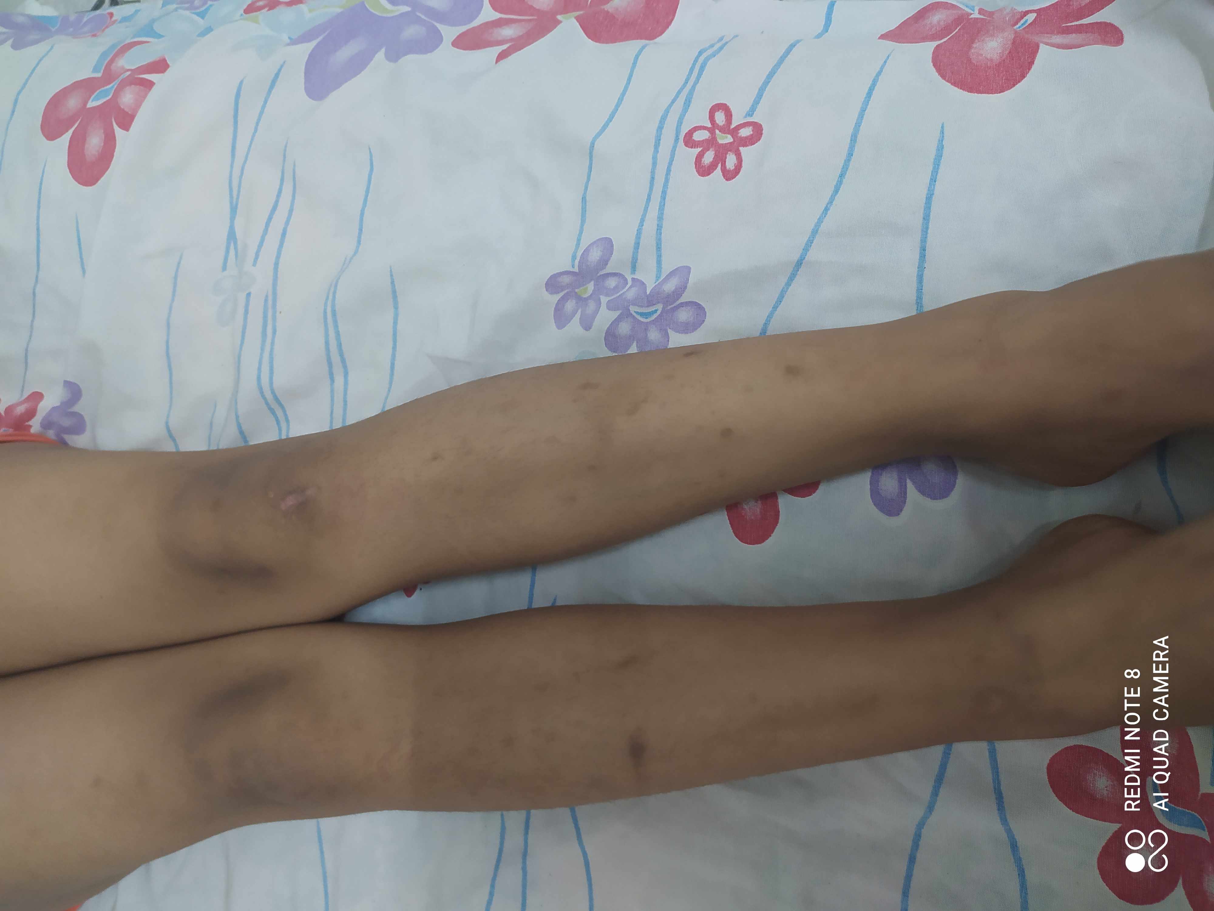 الطفله عندها دوائر بنية بالجلد فى الساقين والذراعين