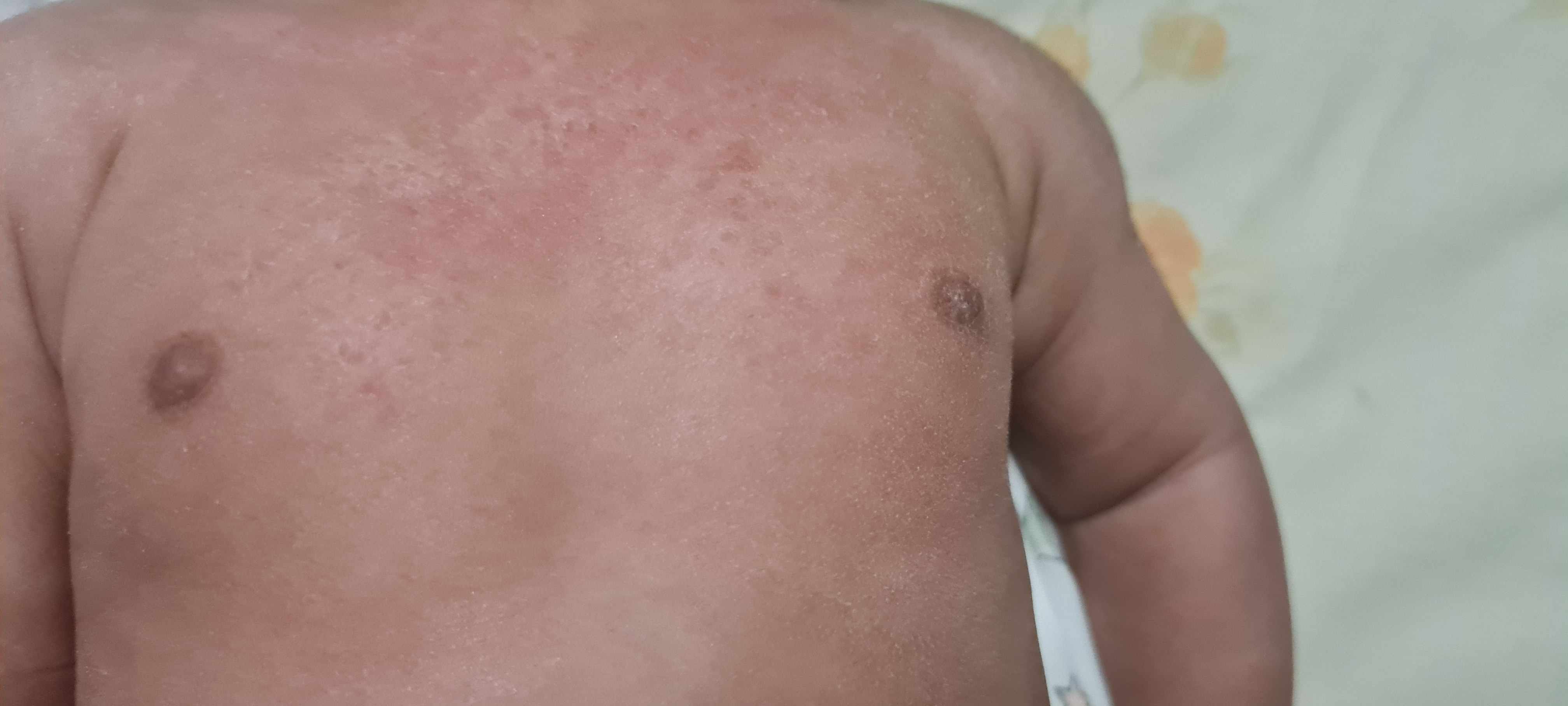 تهيج واحمرار في جلد صدر واكتاف الطفل