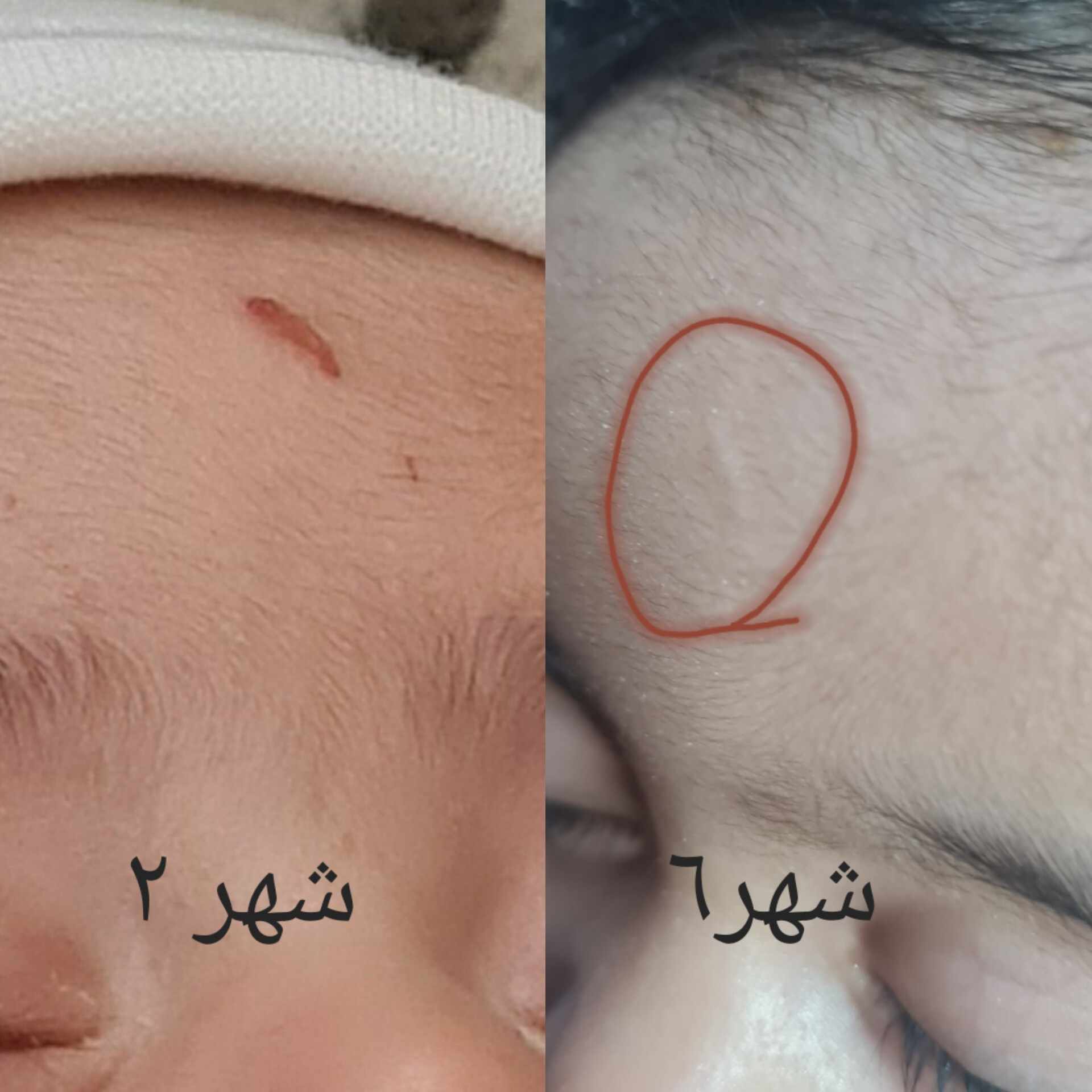 ازالة ندبة الجرح