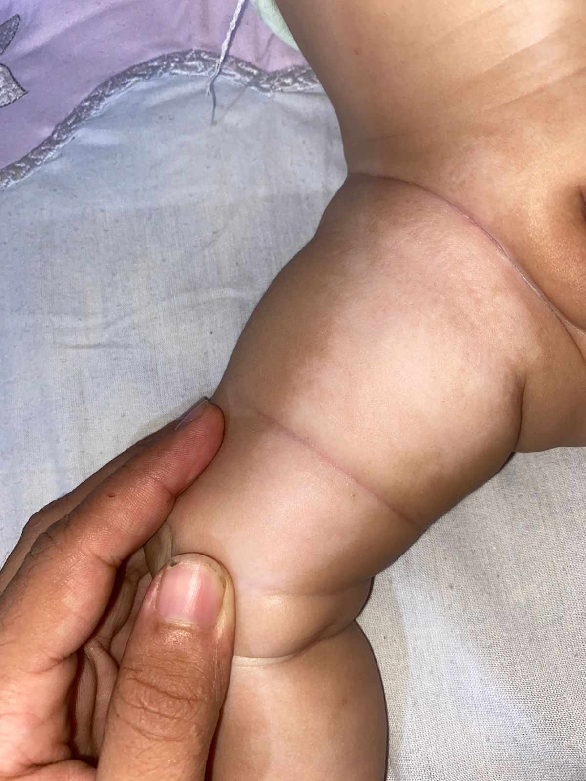 بقع بيضاء كبيرة على جسم الطفل الرضيع: 6 أسباب