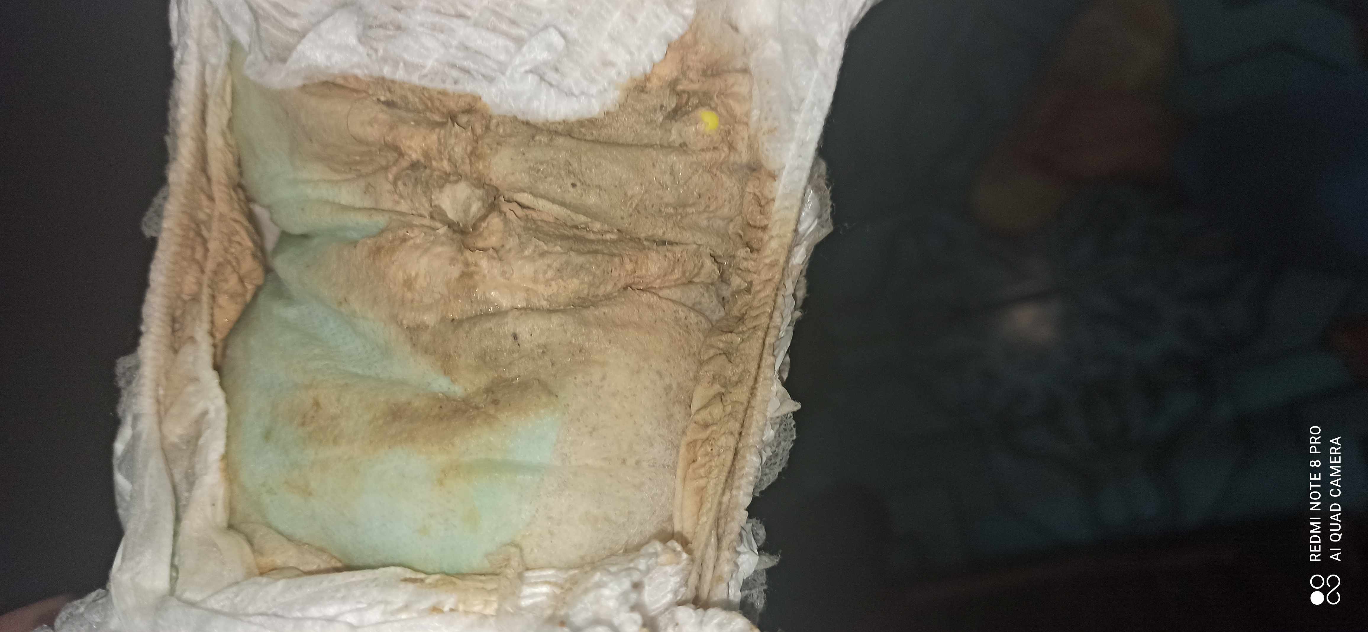 لون البراز أبيض مصفر عند الأطفال