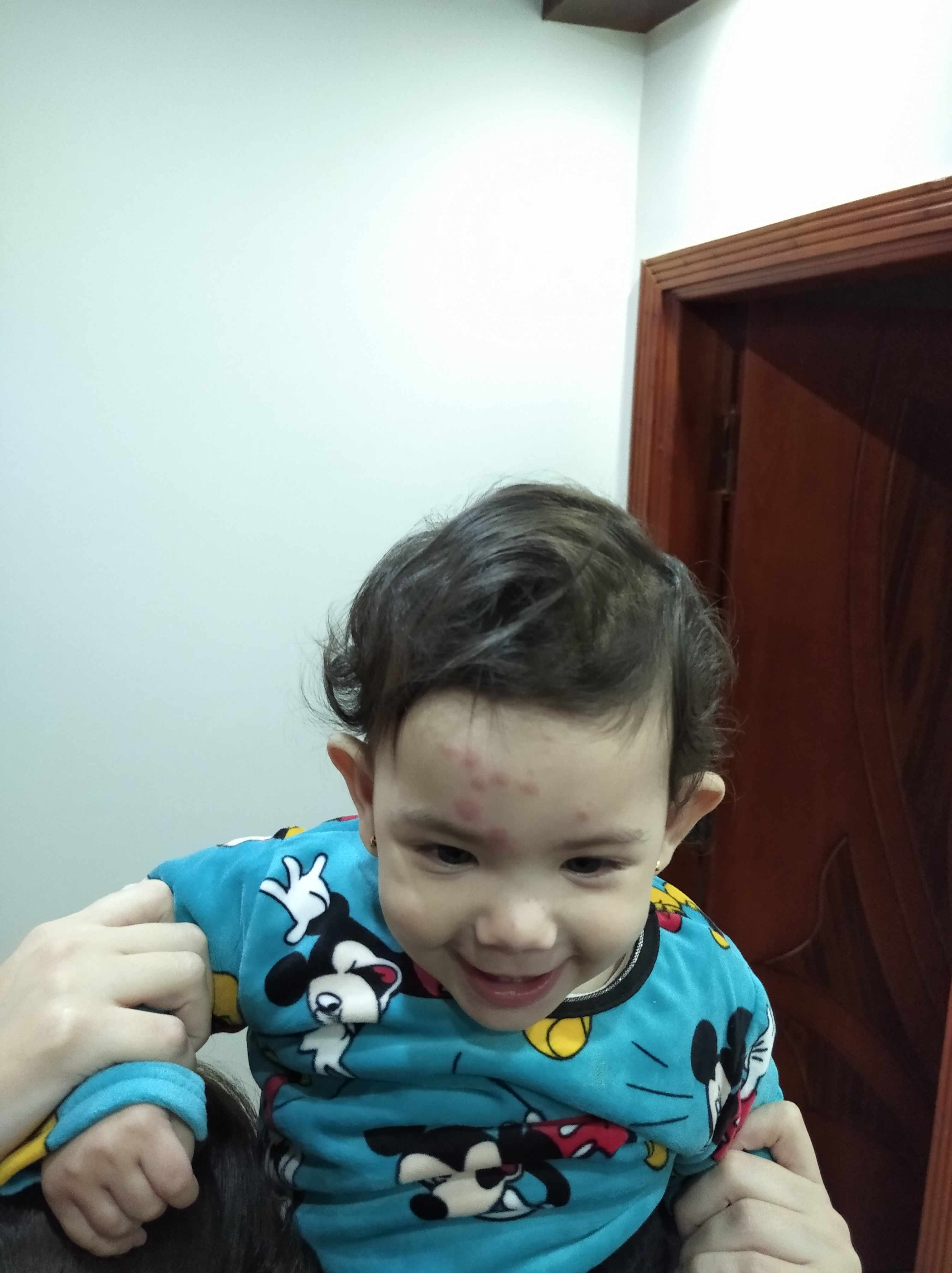 حبوب على جبهة الطفل