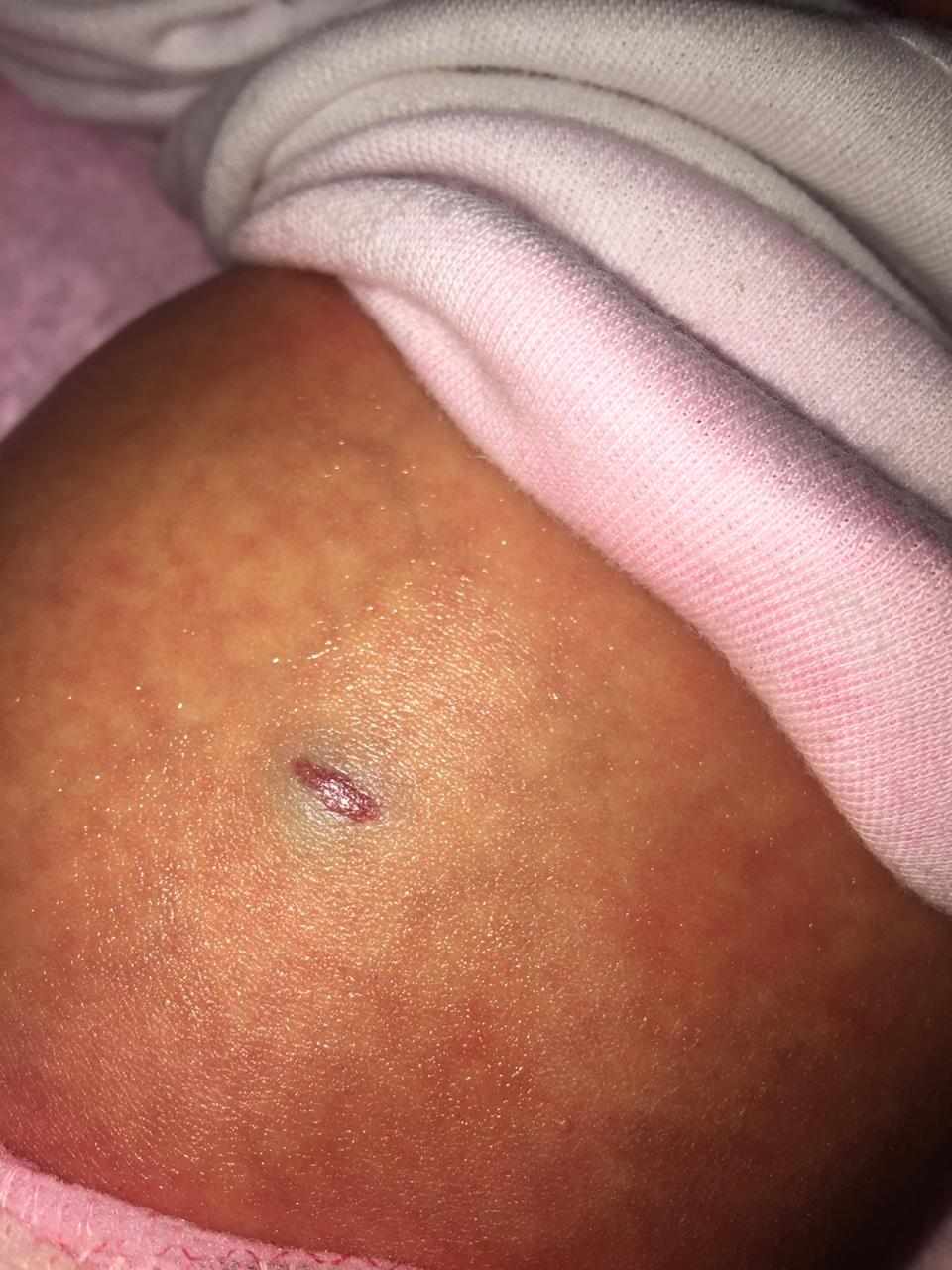 حبة لونها احمر على بطن المولود