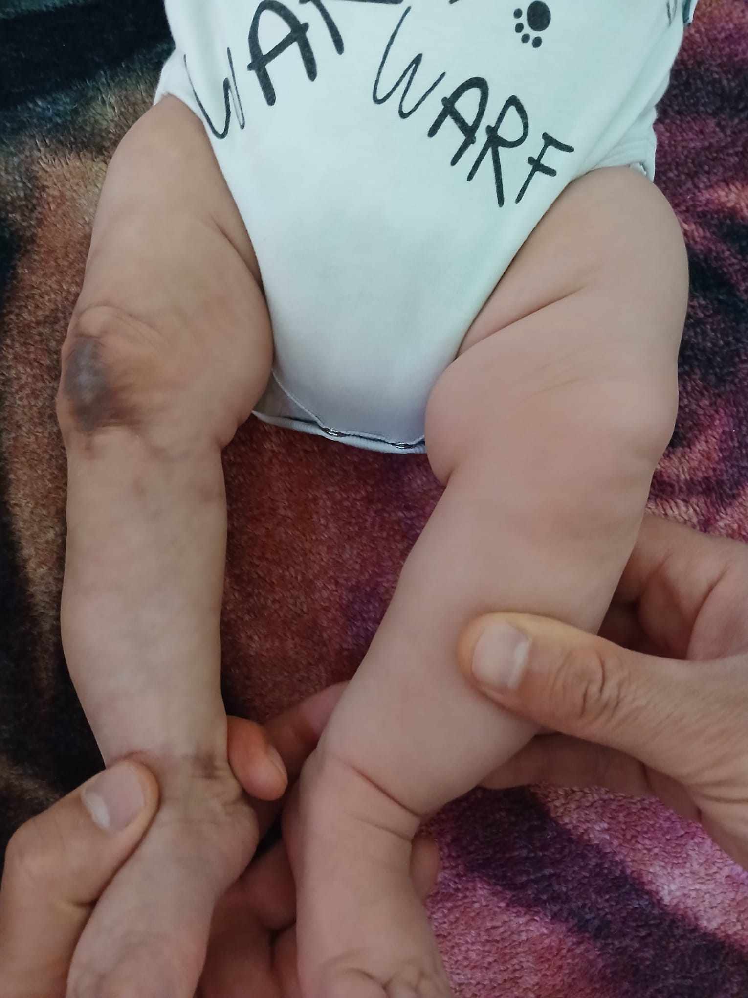 ضمور في الطرف الايمن مقارنة بالايسر مع وحمة منذ الولادة