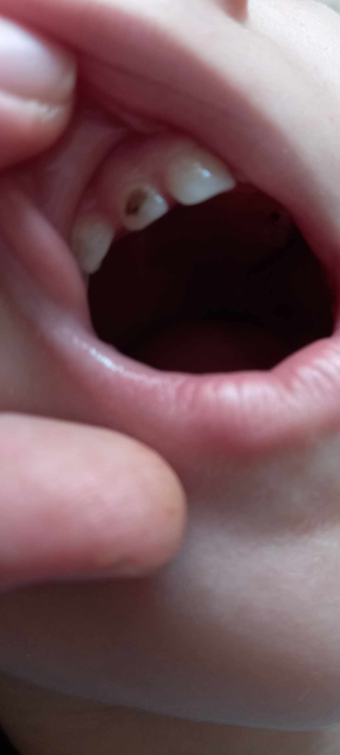 أسباب ظهور بقع سوداء على أسنان الأطفال