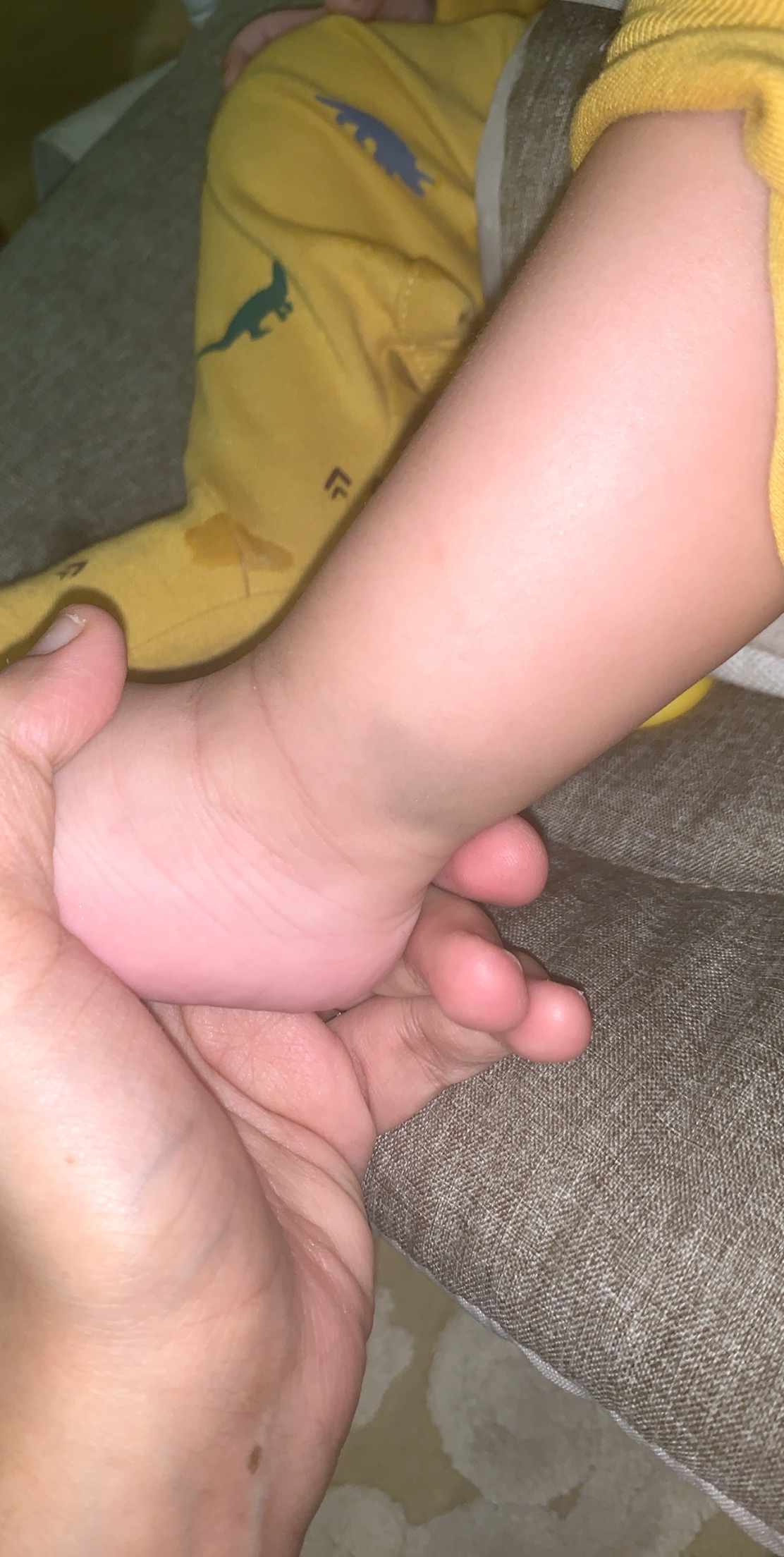 بقعه زرقاء في اسفل ساق الطفل الرضيع