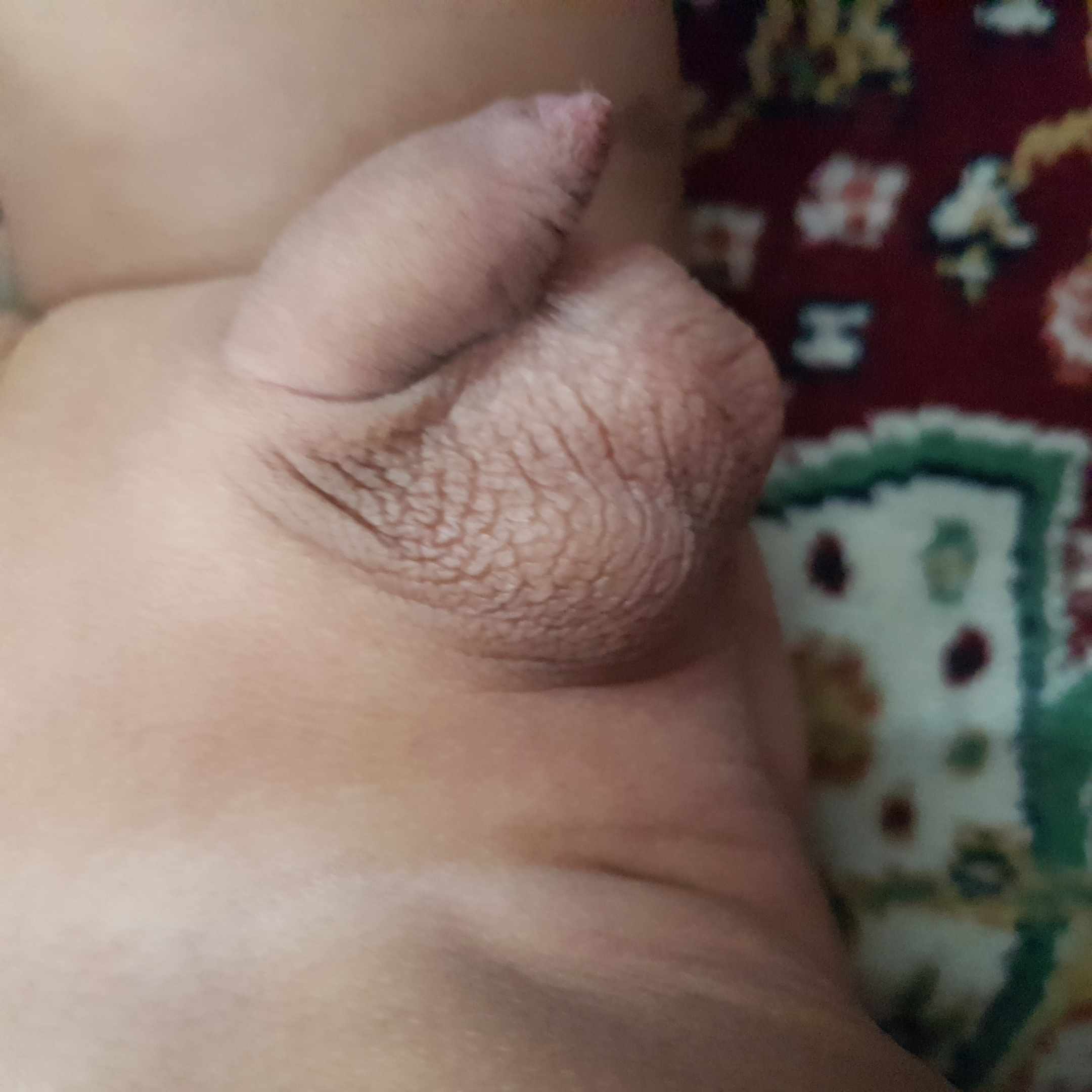 انتفاخ في الخصيه اليسرى للطفل