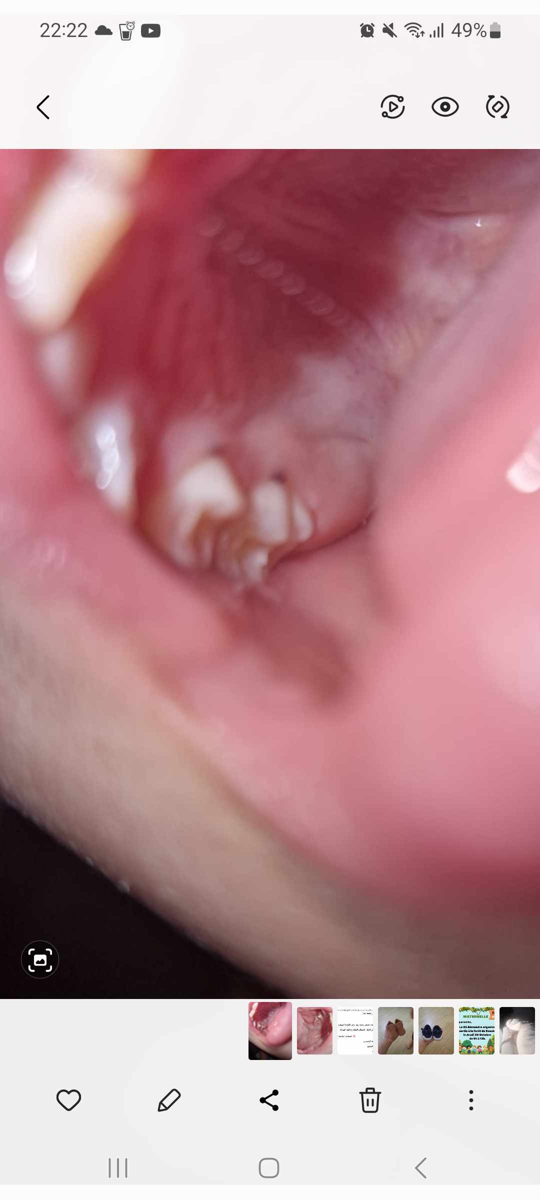 نقطة سوداء بين اللثة والضرس