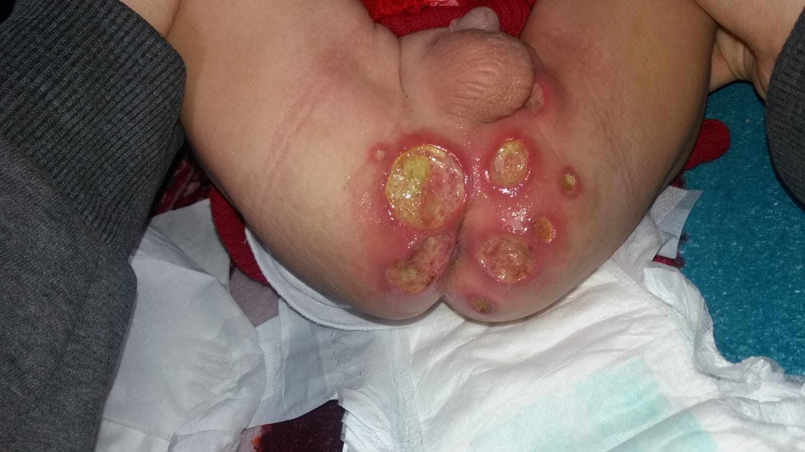 طفلي لديه تقرحات في مقعده (مؤخرته)