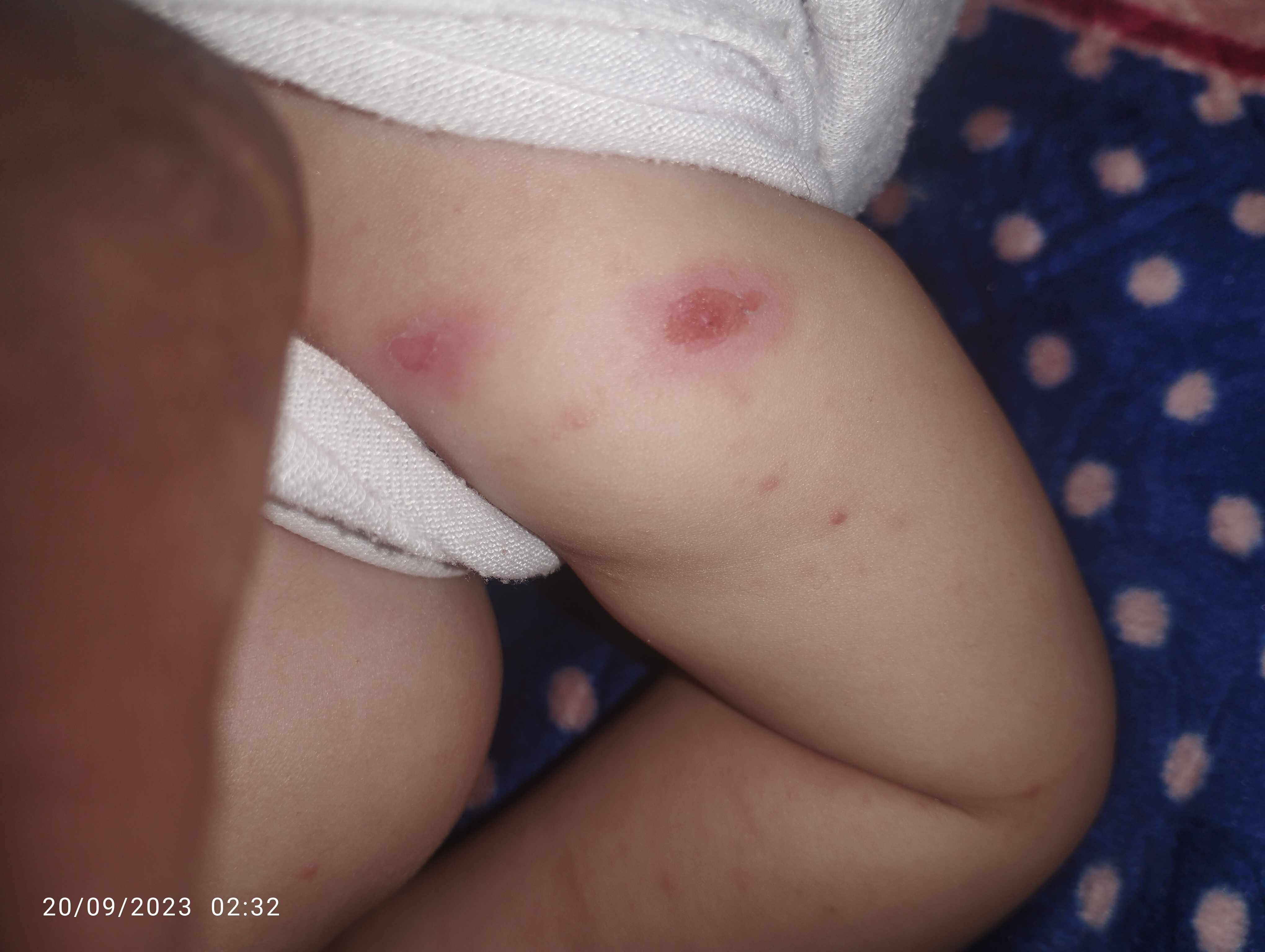ما سبب ظهور حبوب مائية في الجسم؟