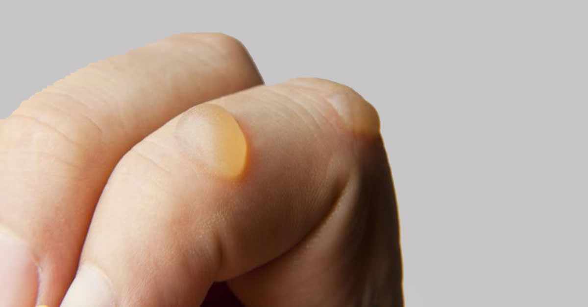 ظهور حبوب فيها ماء فجأة