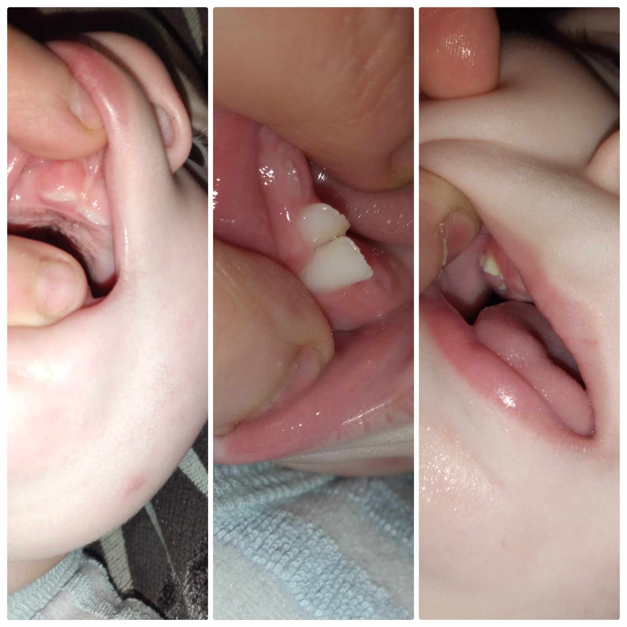 اعوجاج الأسنان اللبنية عند الرضع