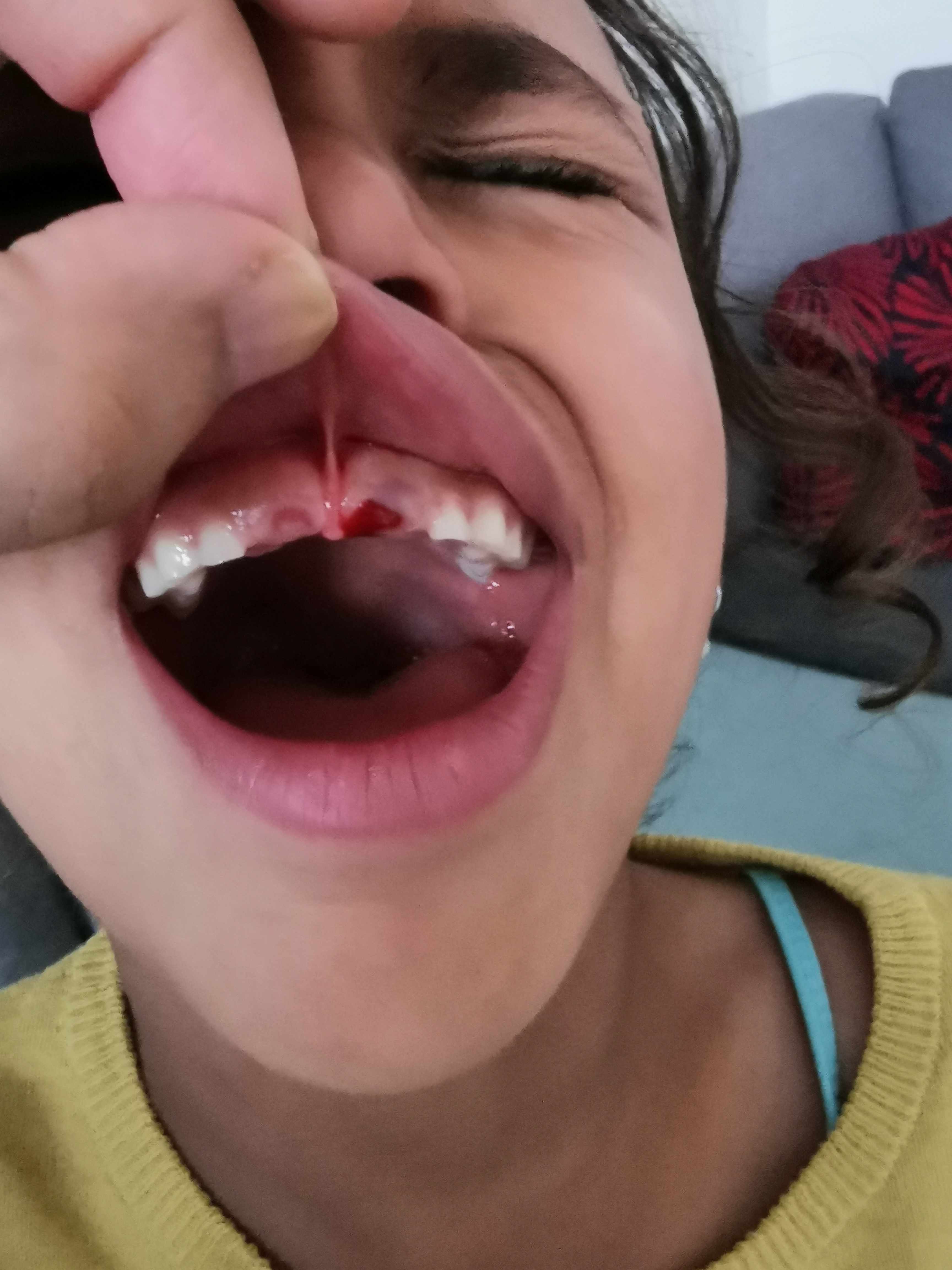 ازرقاق اللثة مكان الخبطة