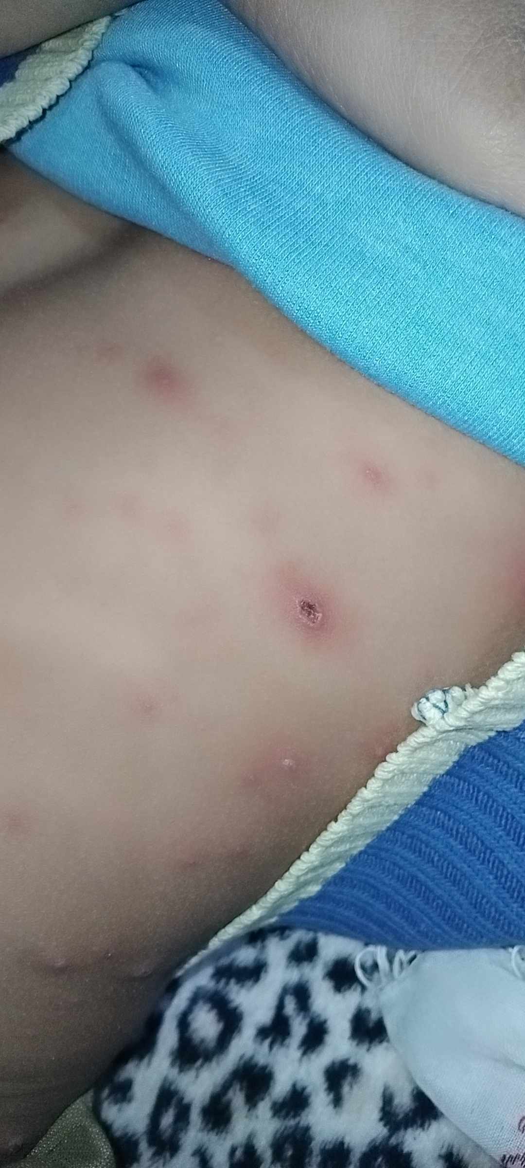 دمامل الجلد عند الاطفال