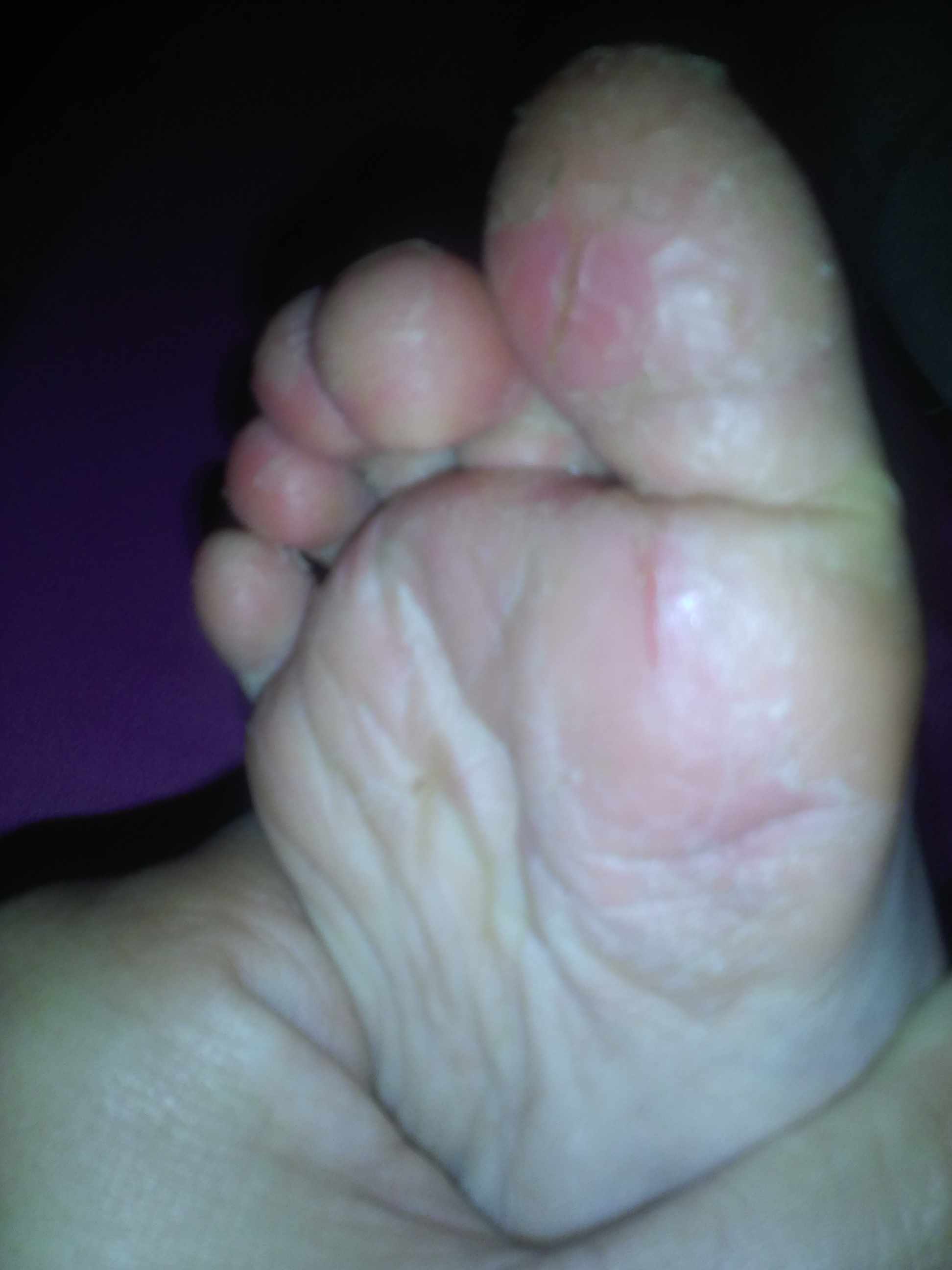 باطن الارجل يحدث فيهما تقشير مع تشقق