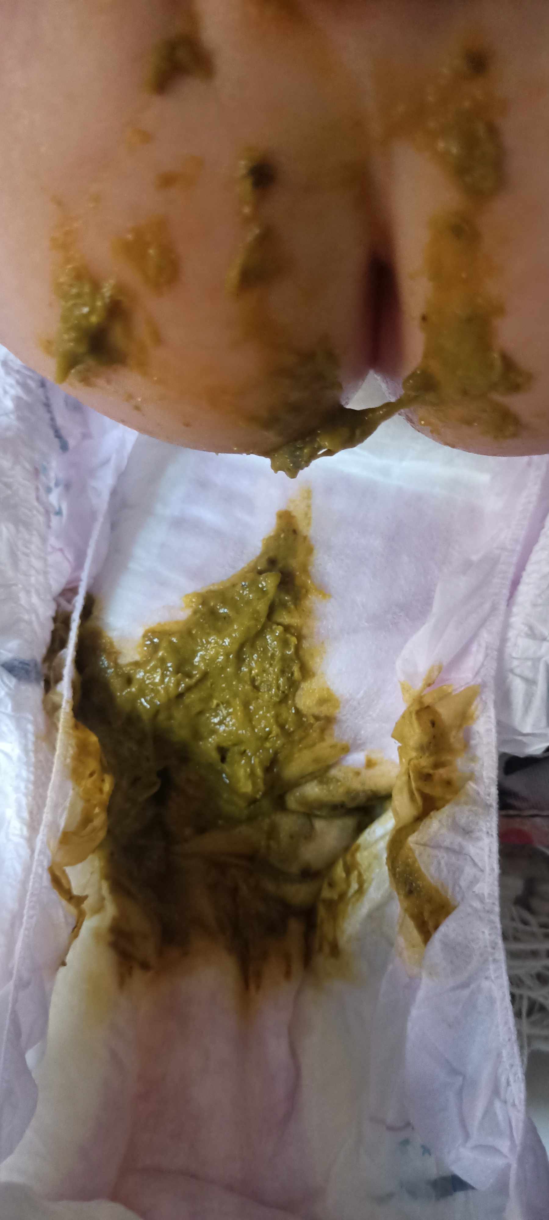 براز الطفل الرضيع طري اخضر: 5 أسباب