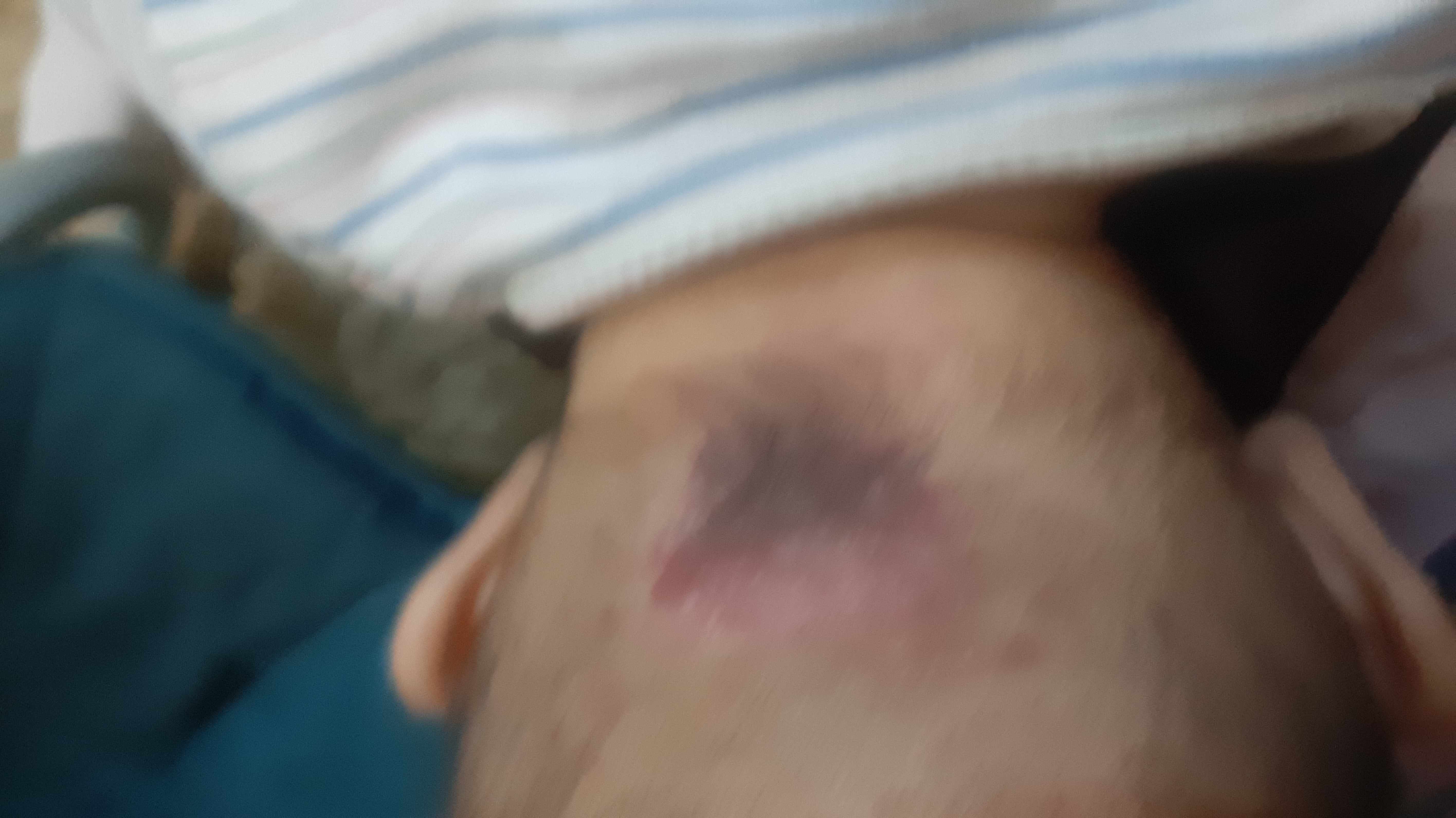 بقعة حمراء خلف رقبة الرضيع