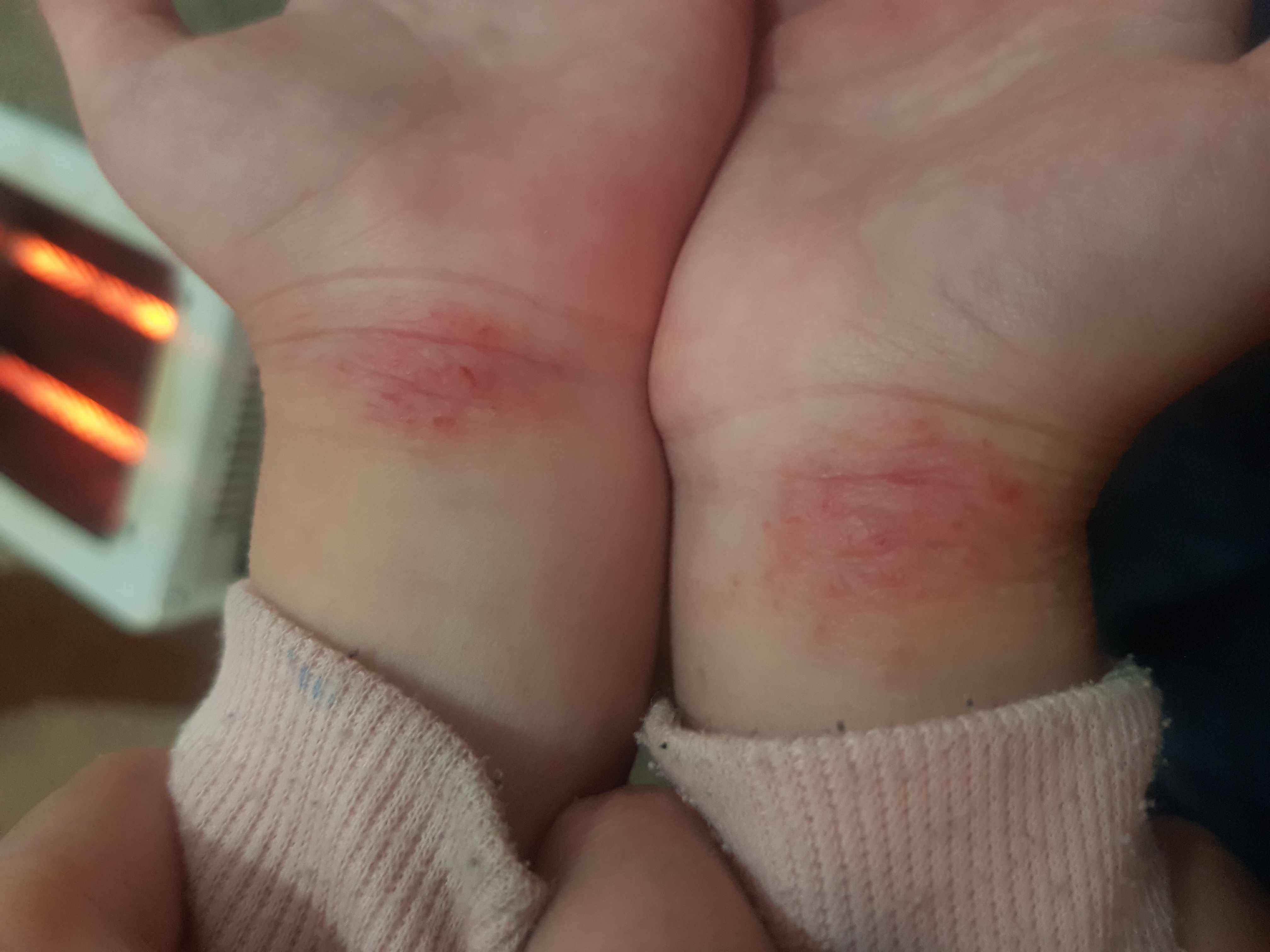 الأكزيما خلف الركبتين