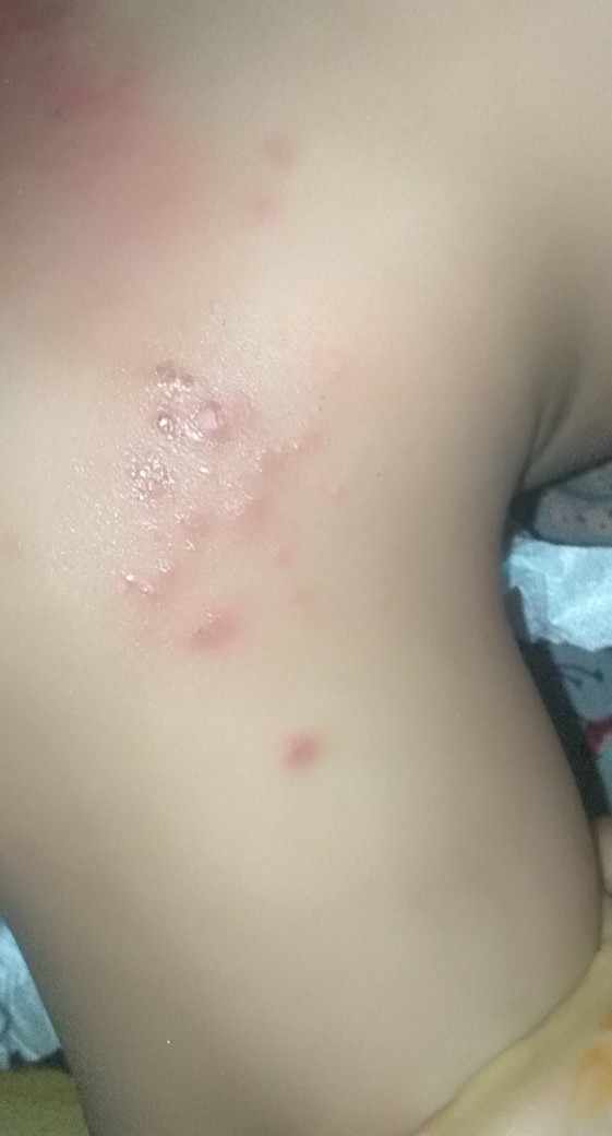 ما سبب ظهور فقاعات صغيرة على الجلد