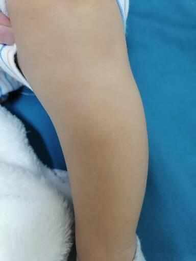 نقاط بيضاء على قدم ابني
