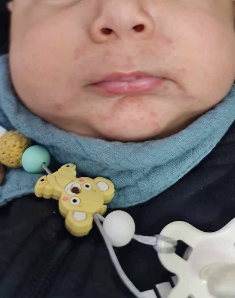 حبوب حمراء حول فم الرضيع: 9 أسباب