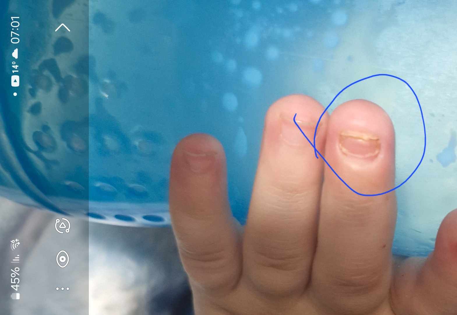 سقوط أظافر الأطفال: 5 أسباب