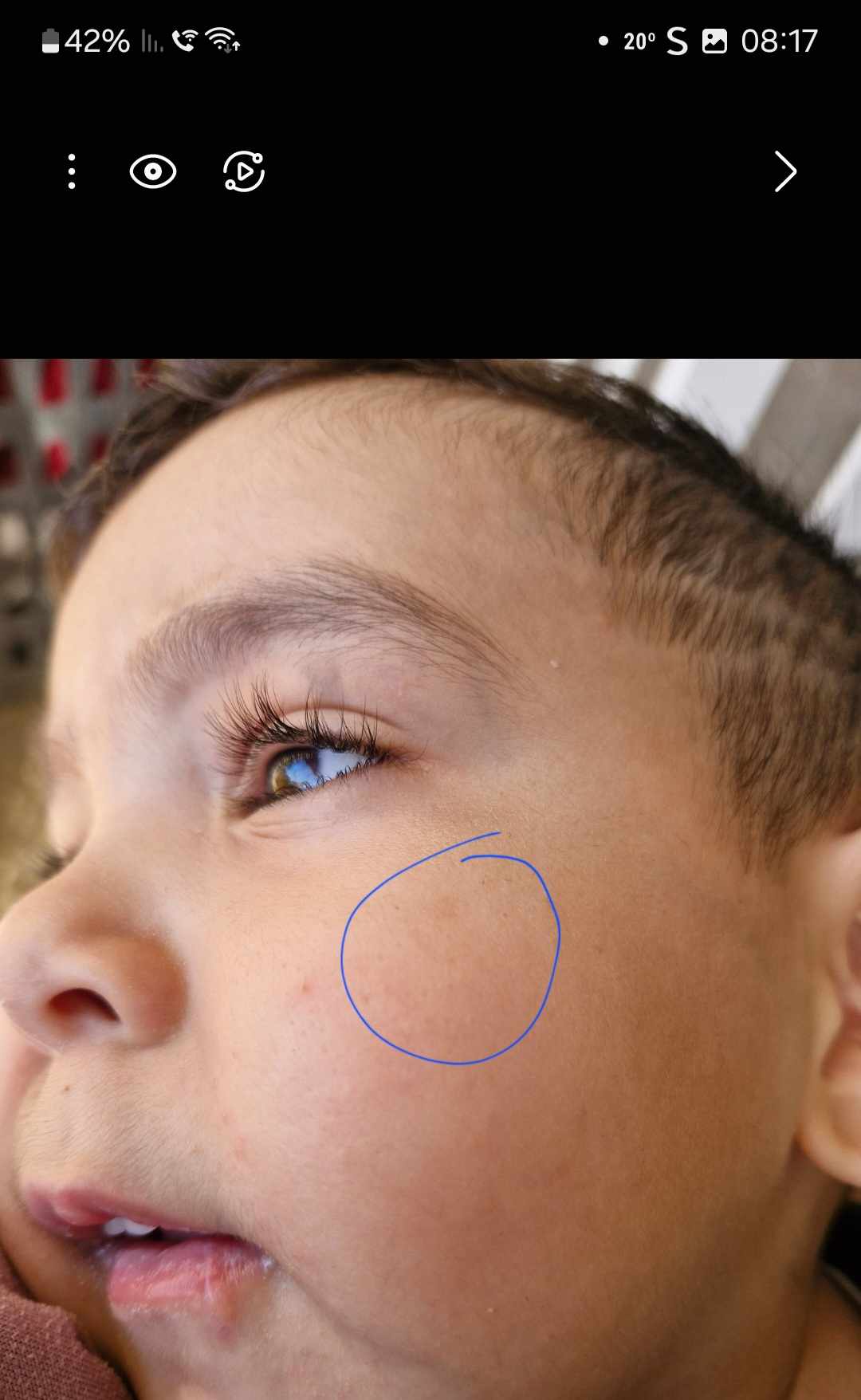 بقع بنية خفيفة على خد الطفل