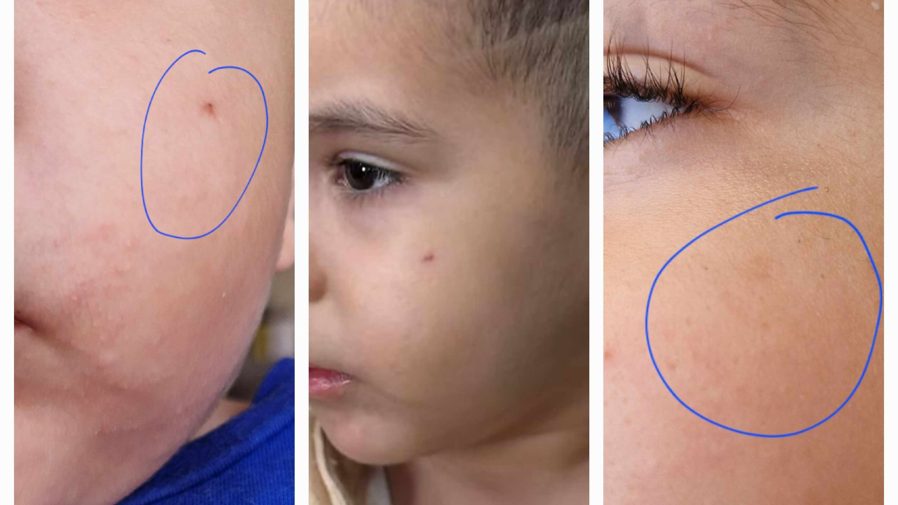 زيادة التصبغ في مكان الجرح أو القشط