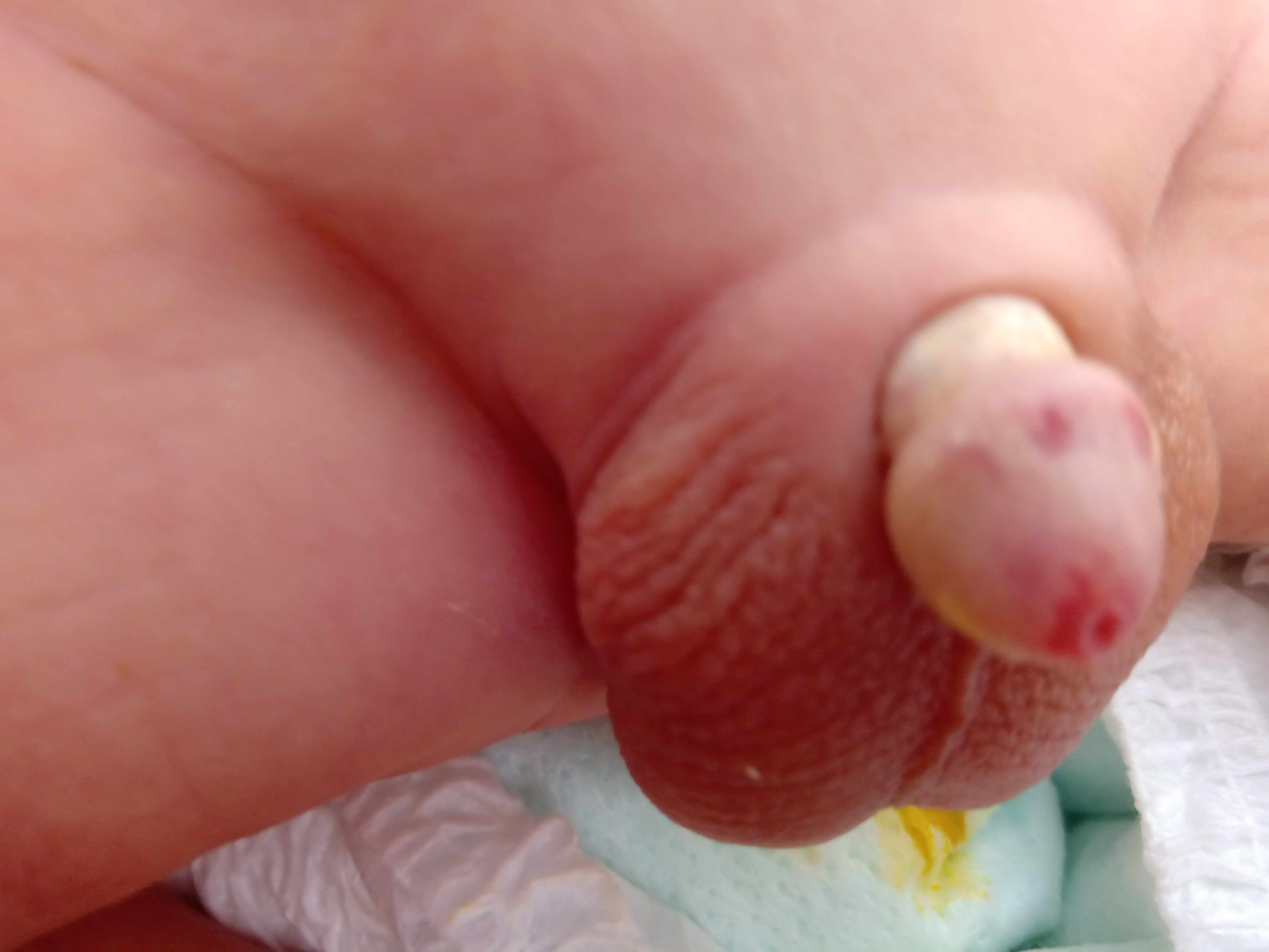 قشرة صفراء على عضو الرضيع بعد الختان