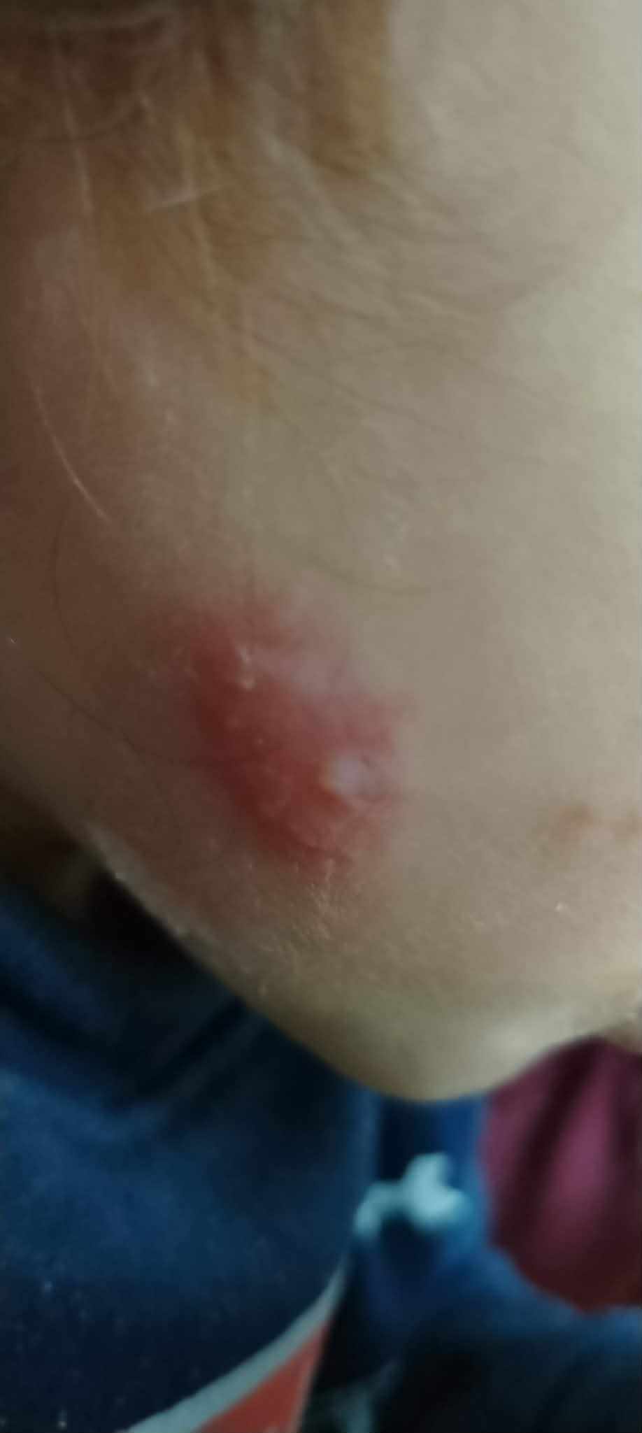 ظهور بقعة حمراء مع فقاعات صغيرة على خد الطفل