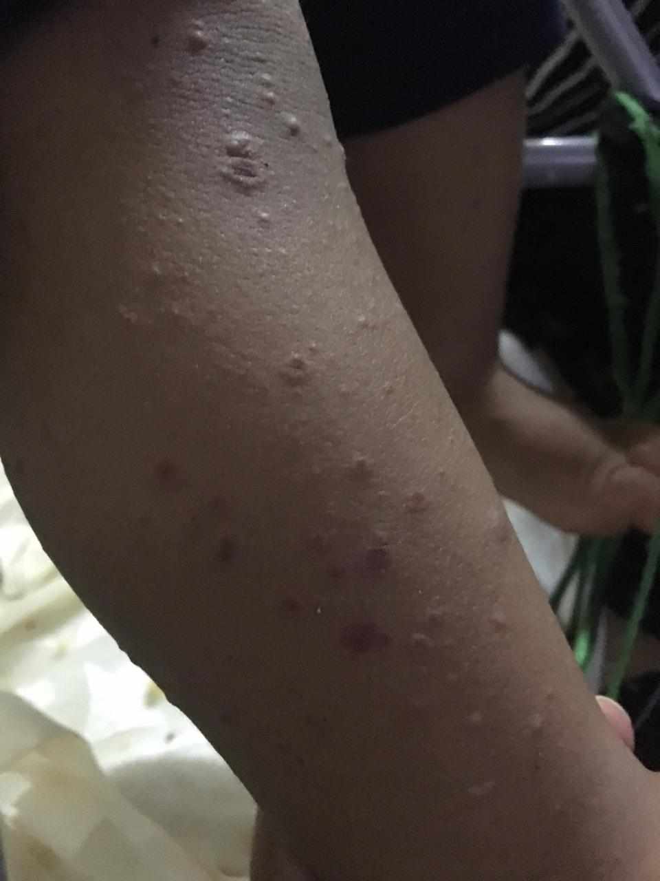 حرارة و التهاب بالحلق و حبوب بالقدم عند الطفل