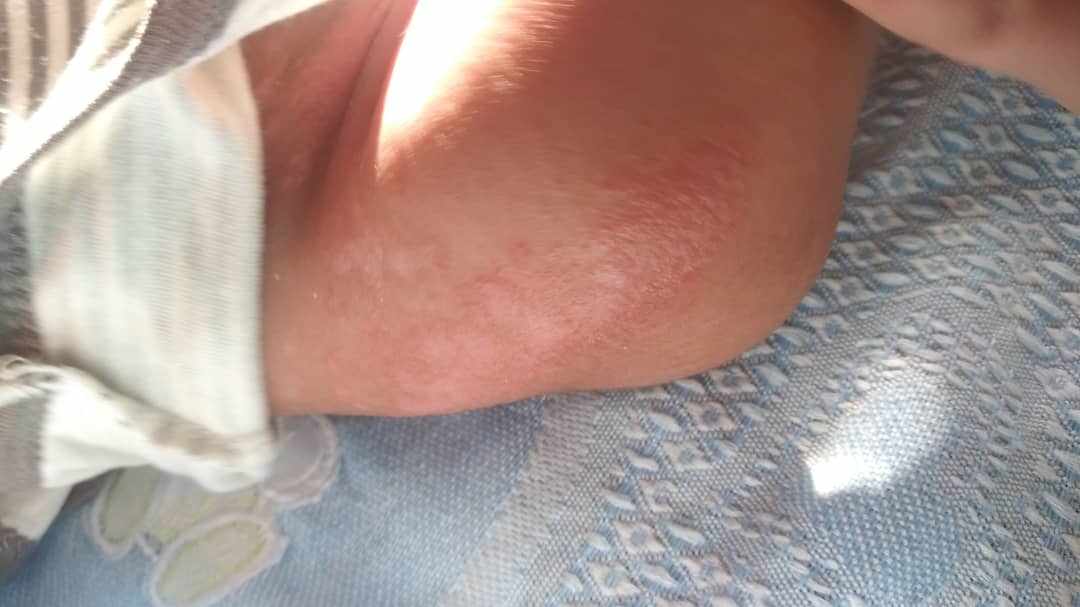 أسباب ظهور فقاعات مملوءة بالماء على جلد الرضيع