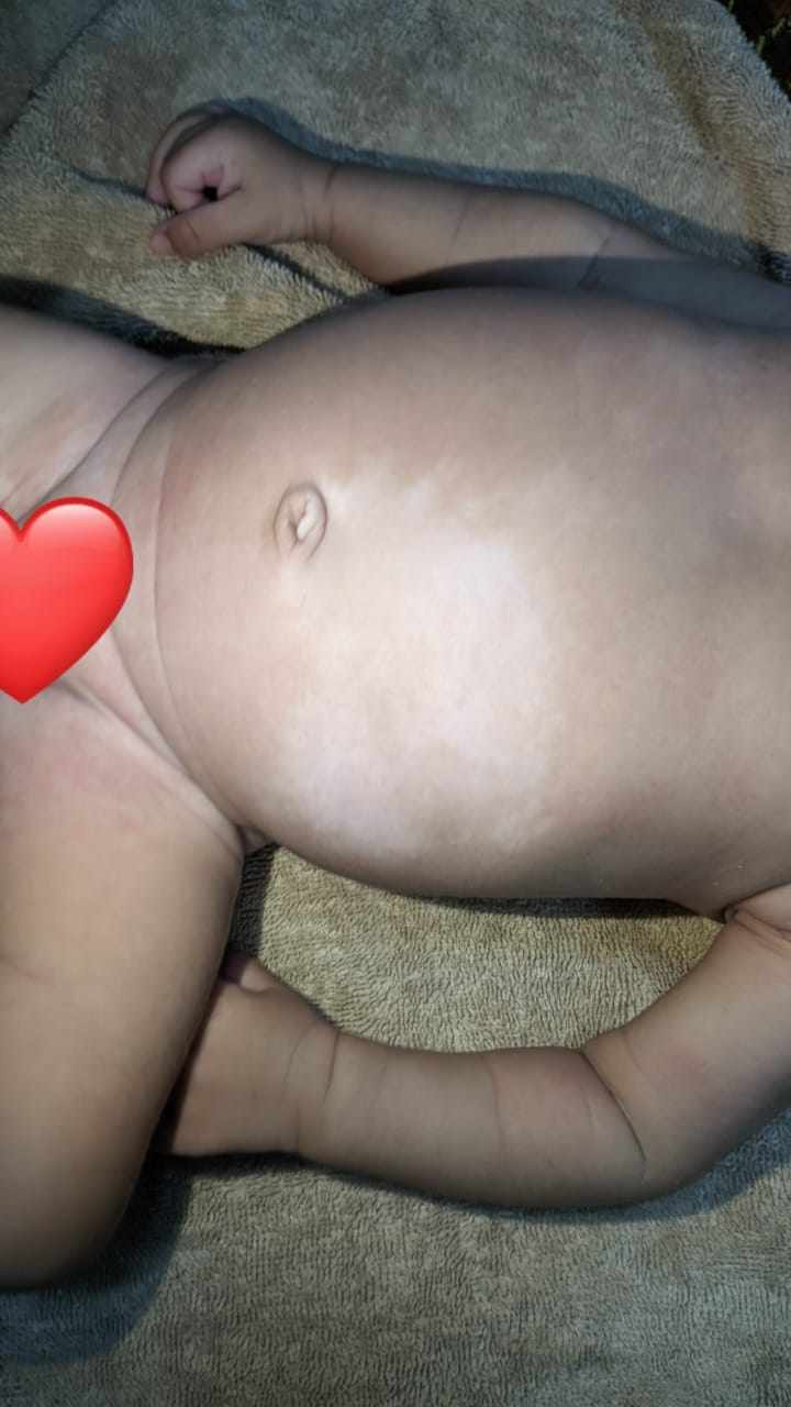 ابنتى عندها بقعه بيضاء كبيره في البطن من الولاده