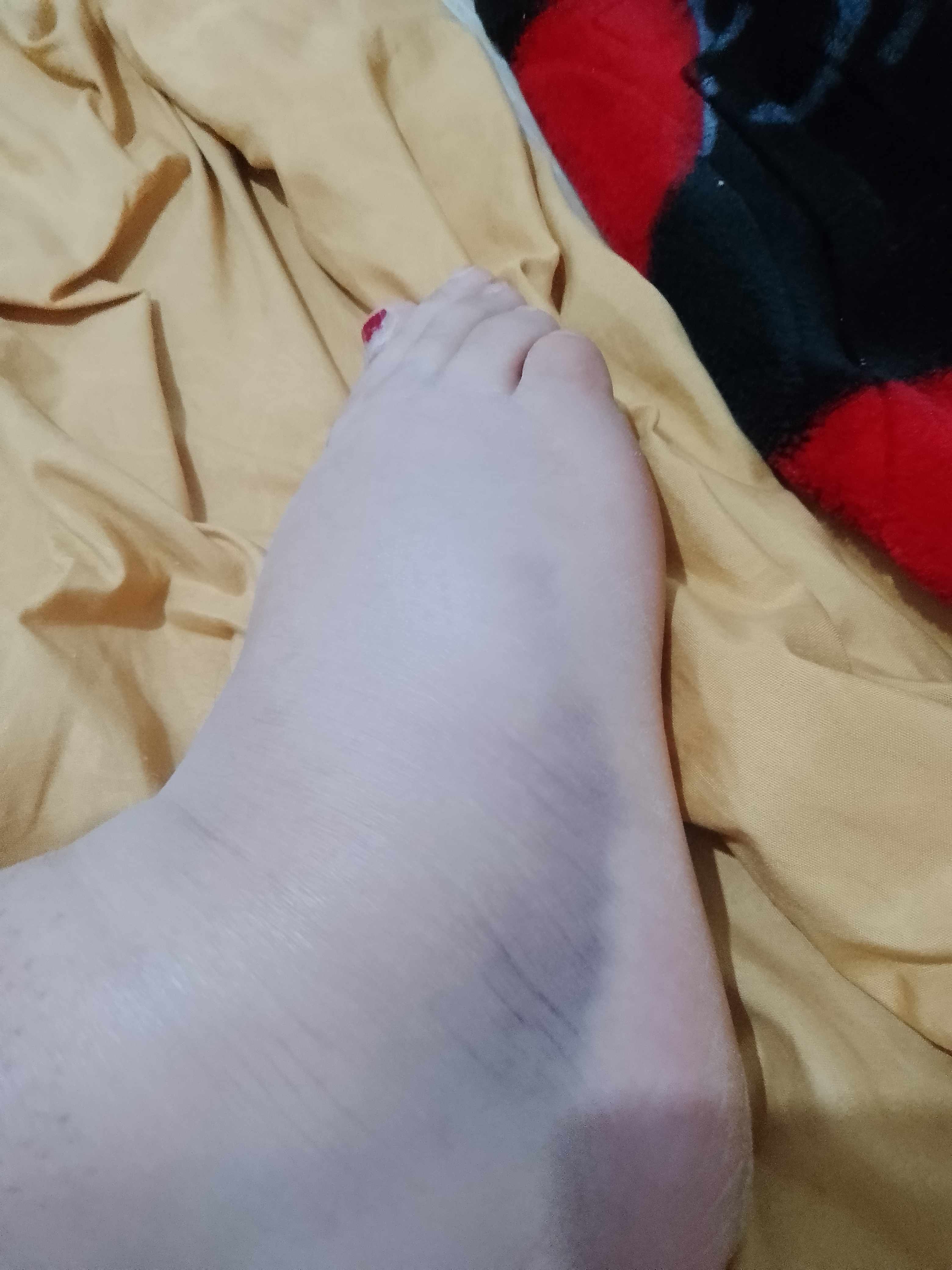 كم مدة تجبير وشفاء كسر القدم؟