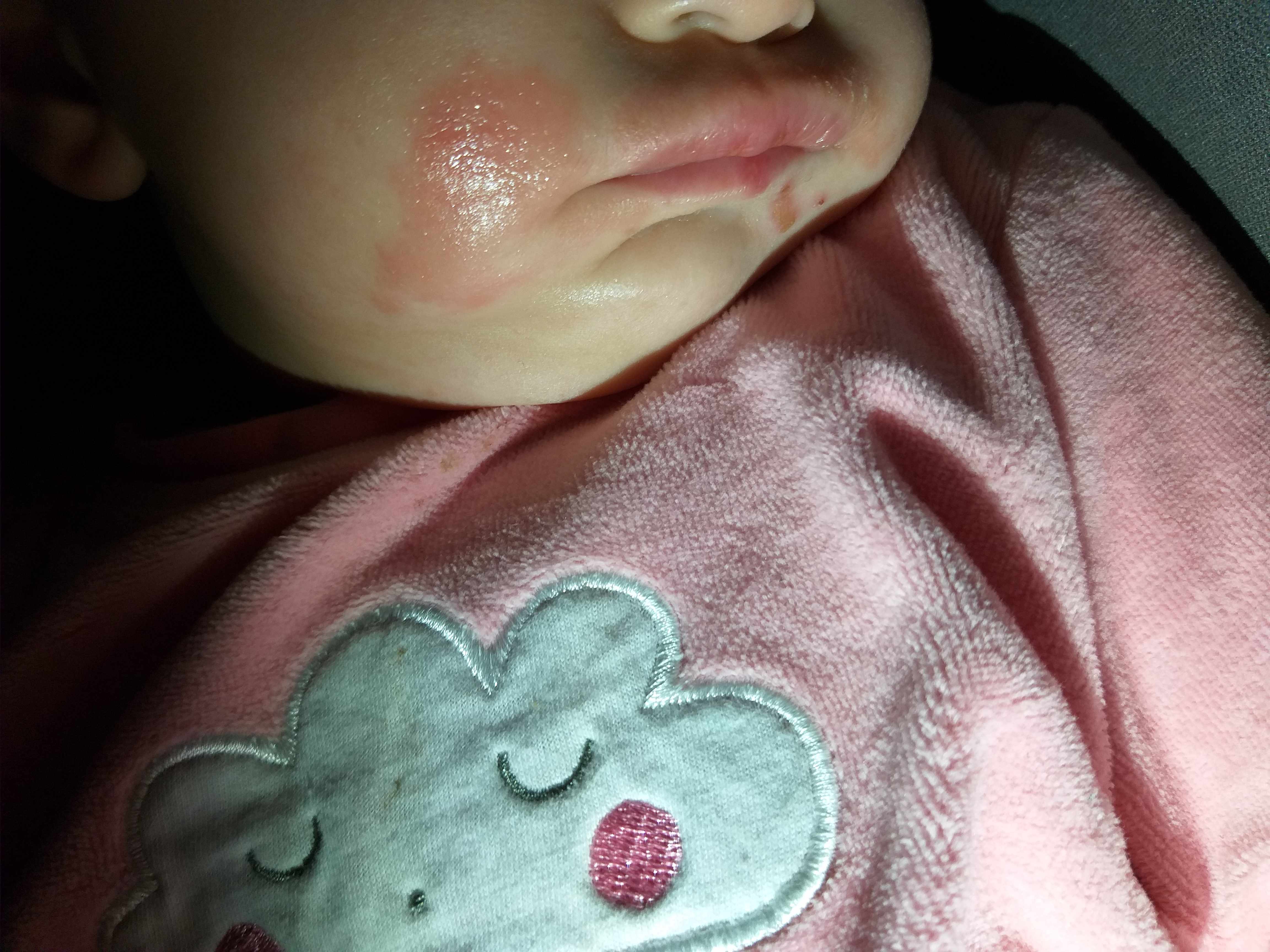 بنتي تعاني من اكزيما في الوجه