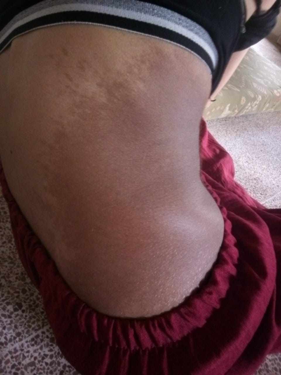 بقعة بنية كبيرة على جسم الطفل