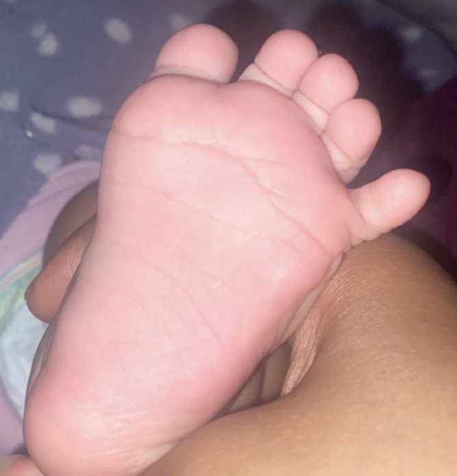 الفرق بين hypochondroplasia و achondroplasia