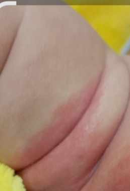 احمرار وحساسية مكان الحفاضة