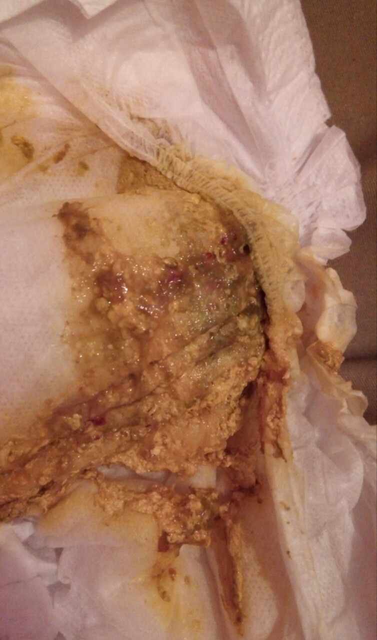 دم في براز الطفل حديث الولادة